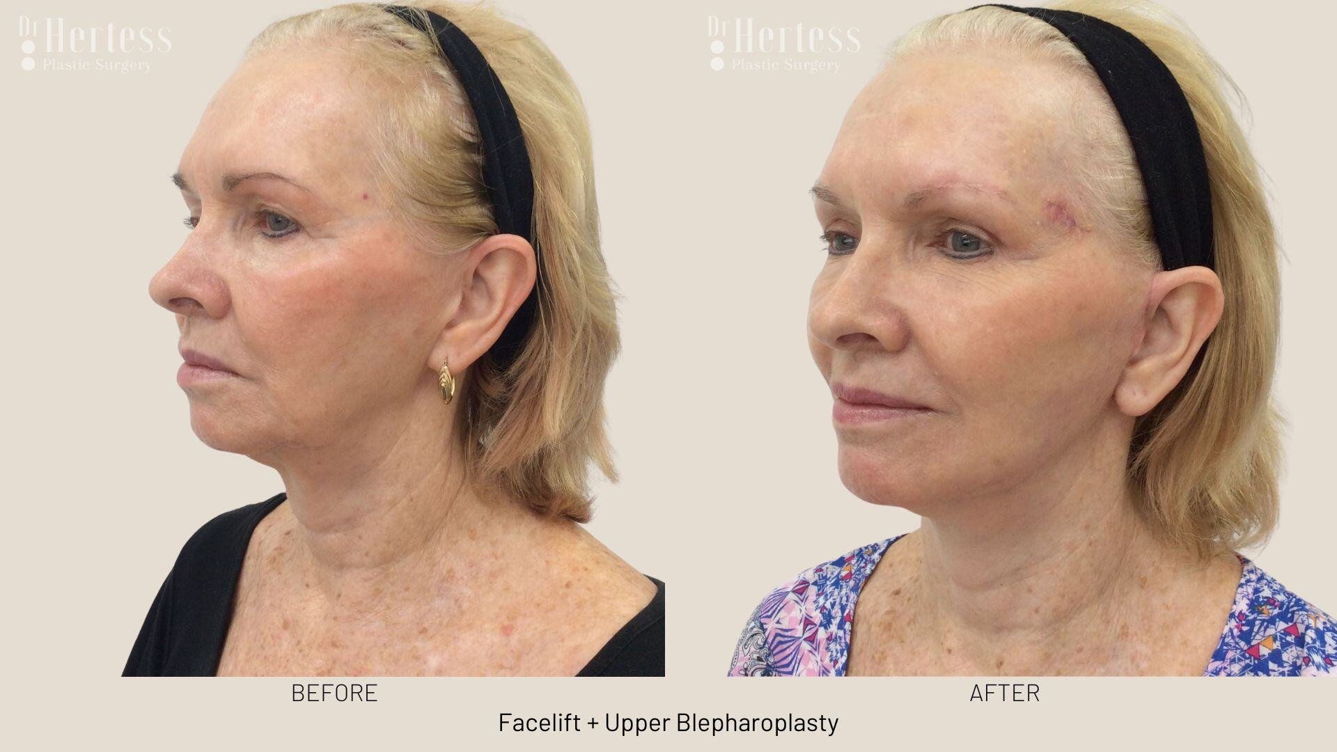 facelift before and after photos