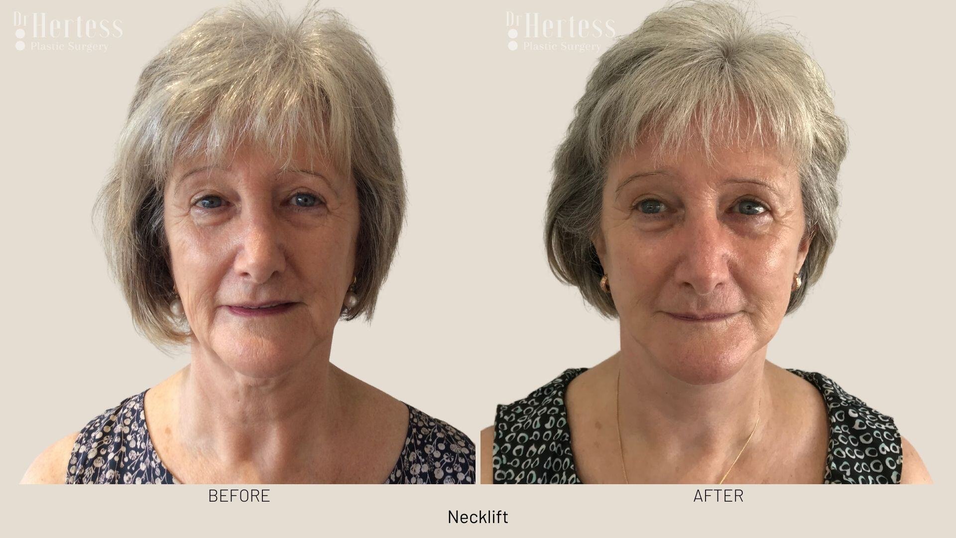 facelift before and after photos