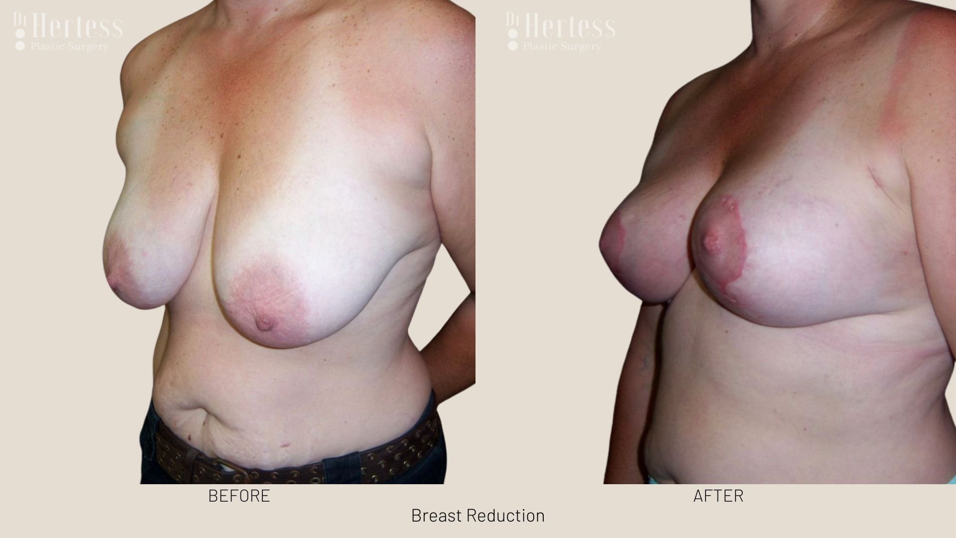 boob reduction before and after