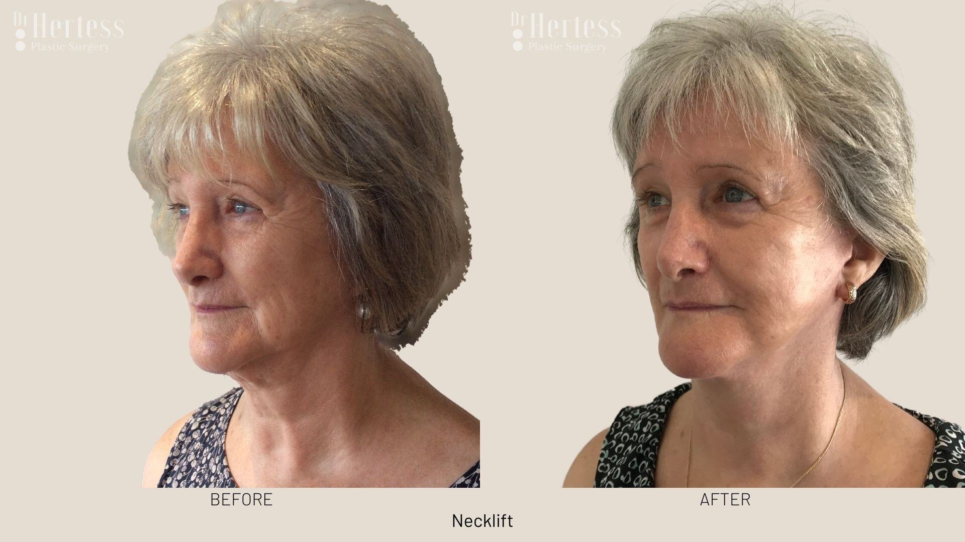 facelift before and after photos