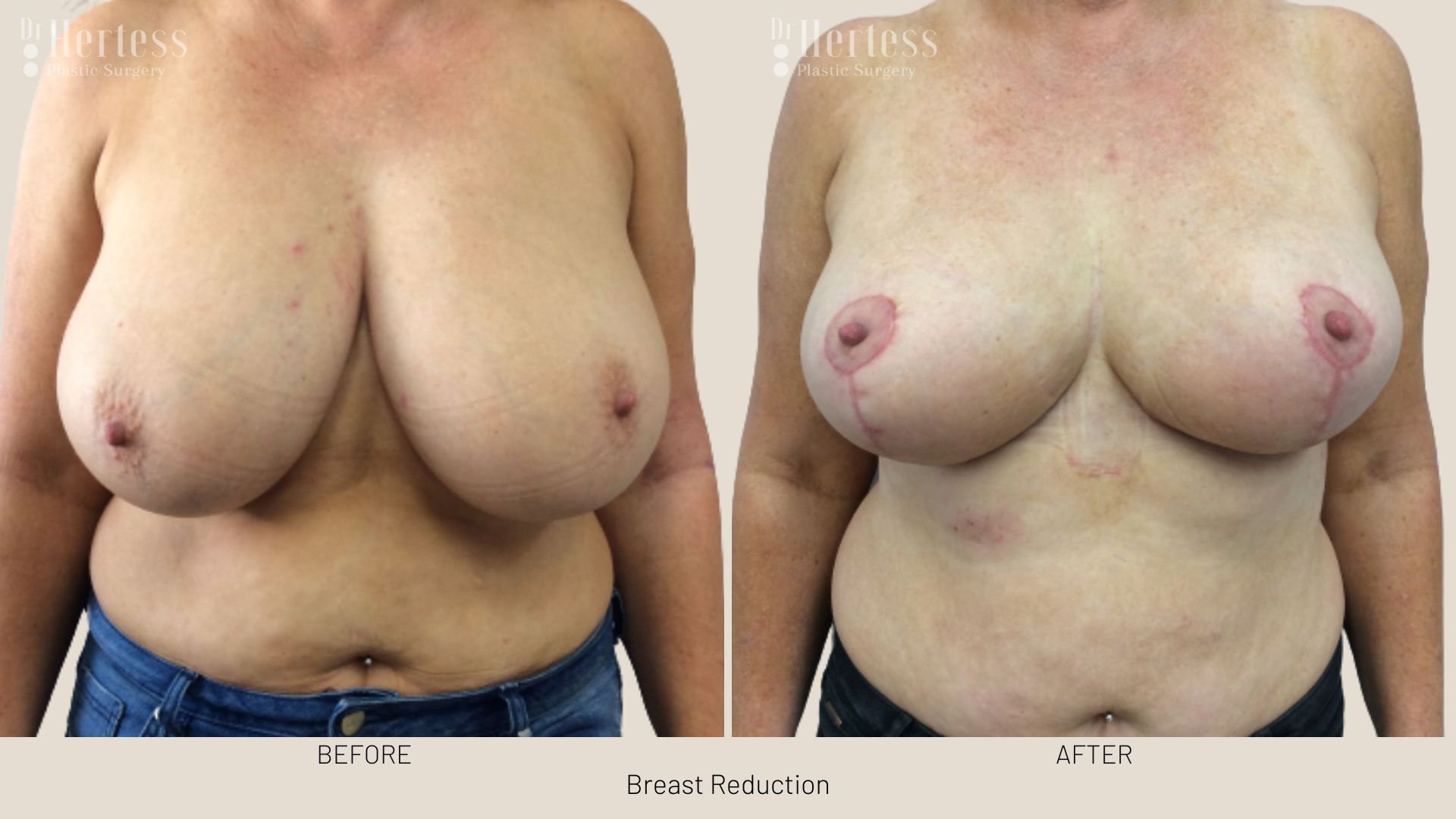 boob reduction before and after