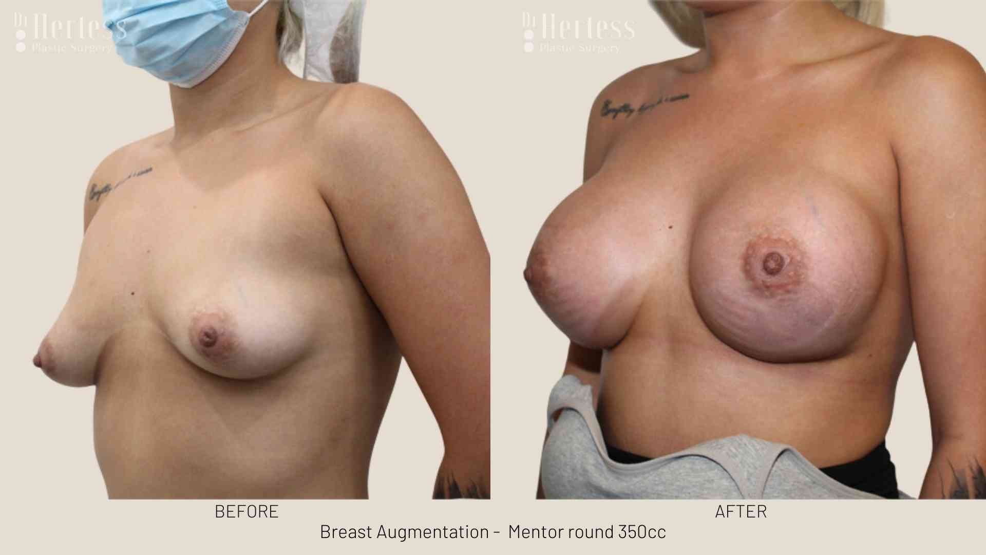 breast enlargement before and after