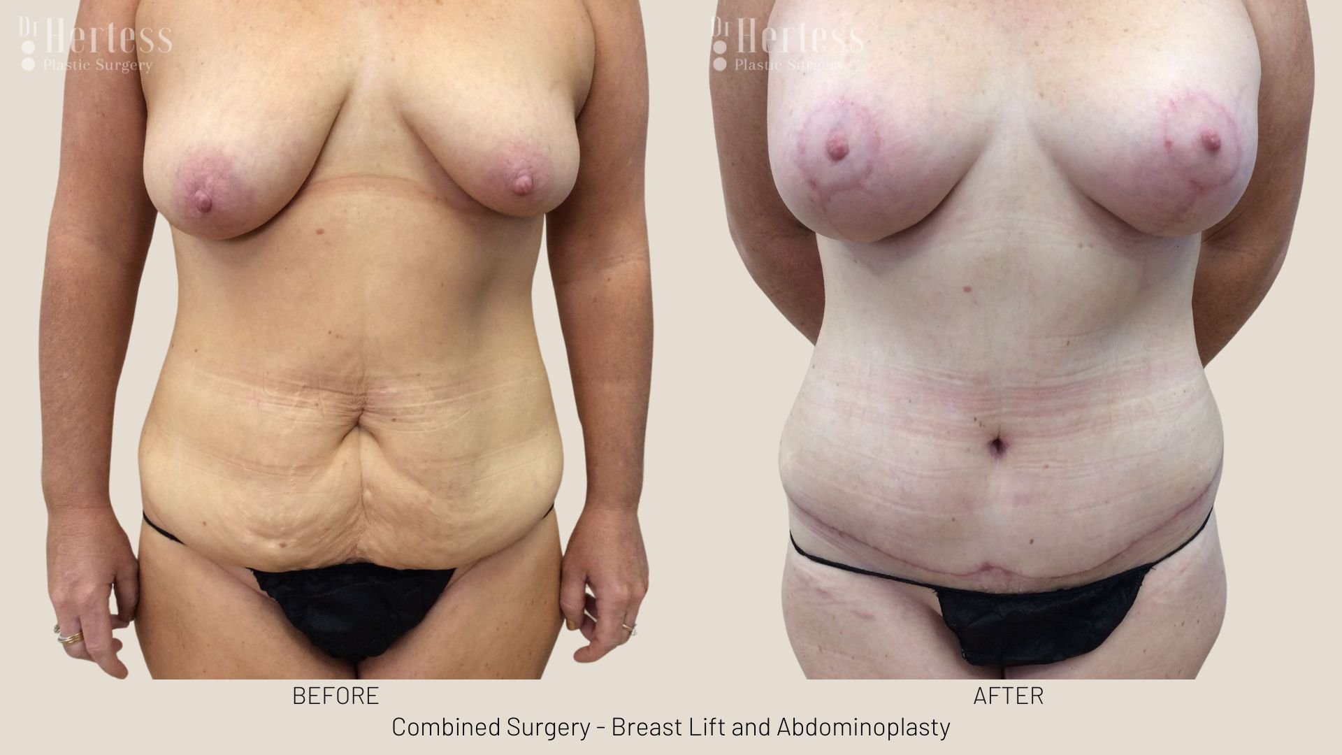 tummy tuck after pregnancy