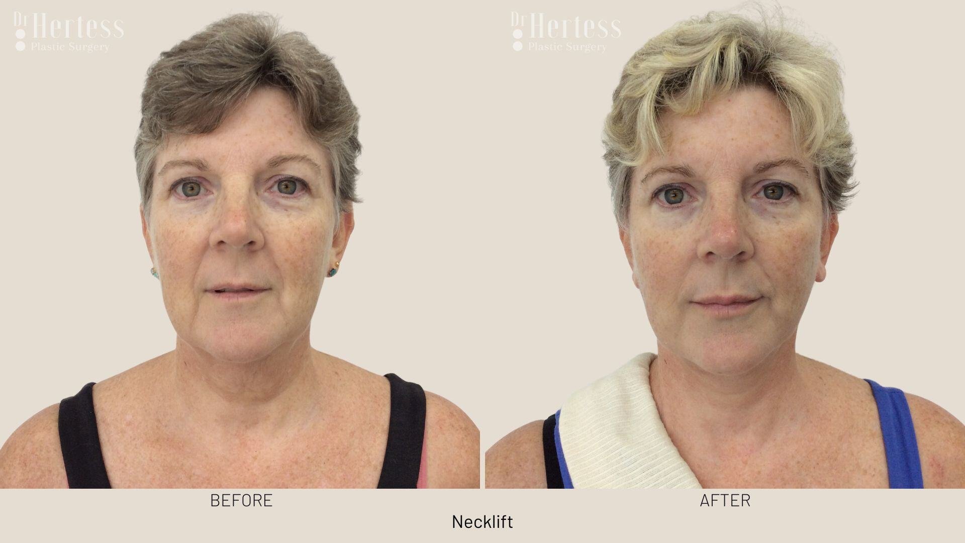 facelift before and after photos