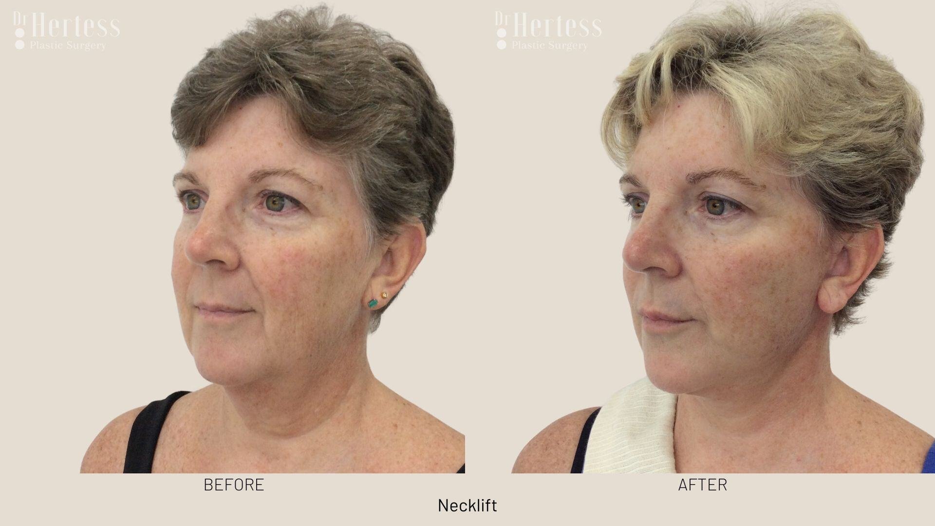 facelift before and after photos