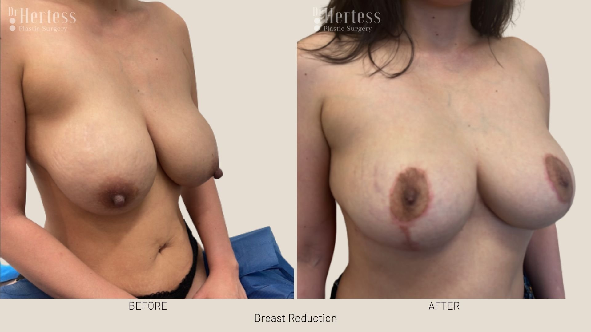 boob reduction before and after