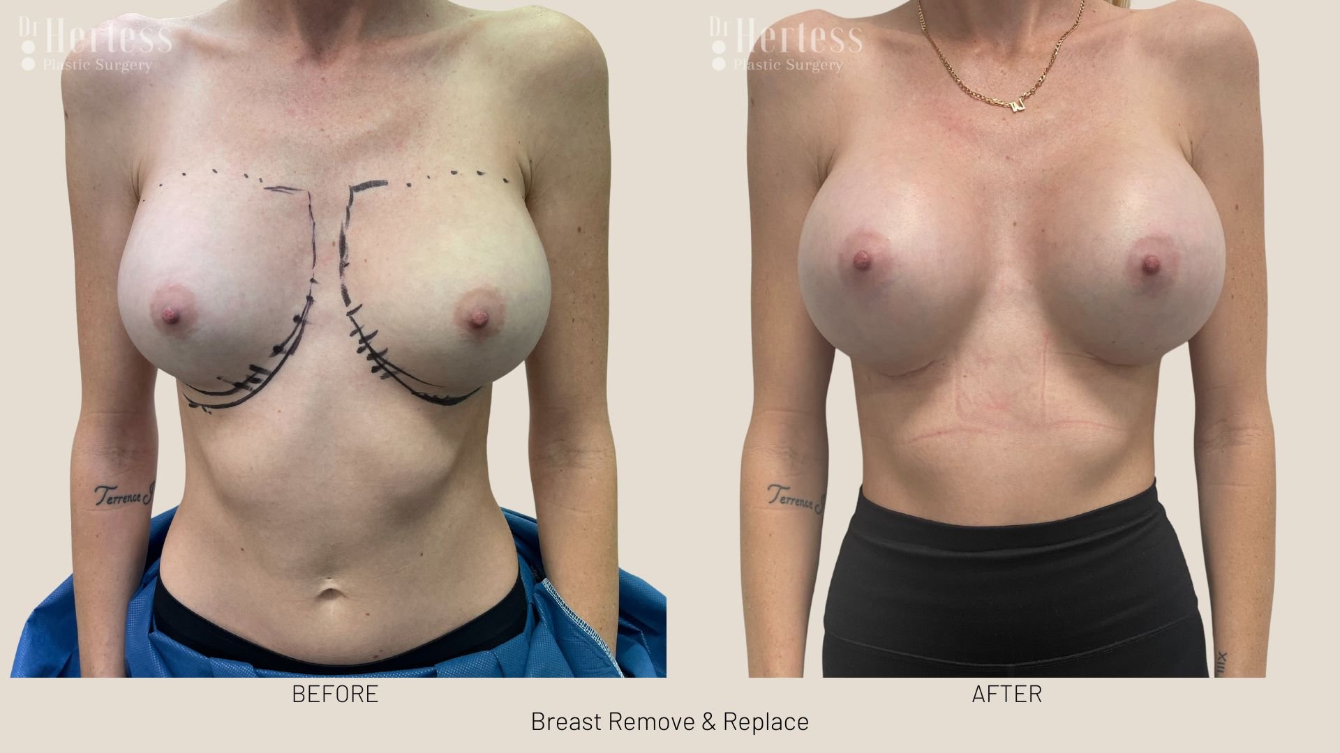 breast implant removal and replacement