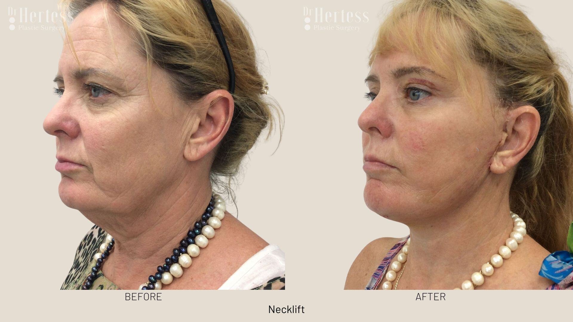 facelift before and after photos