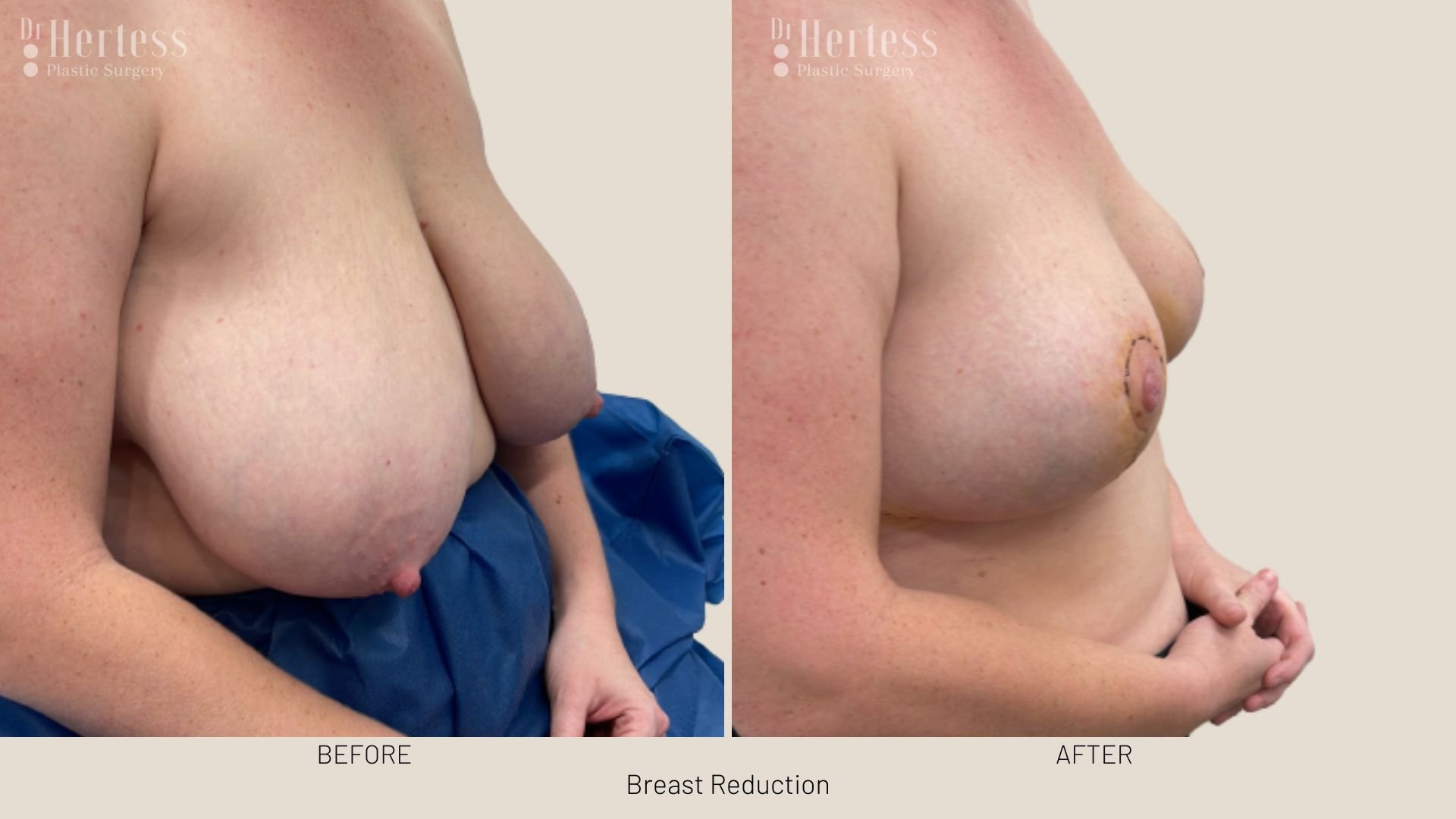 boob reduction before after