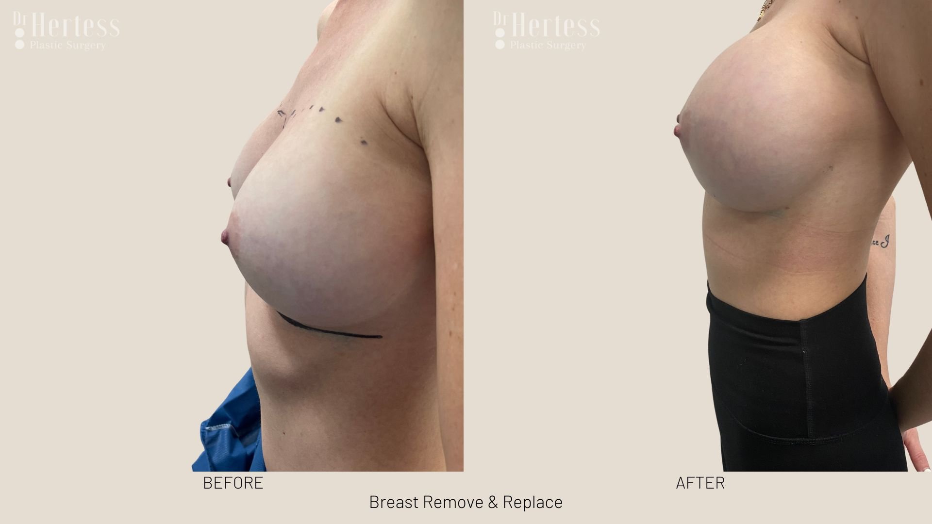 breast implant removal and replacement