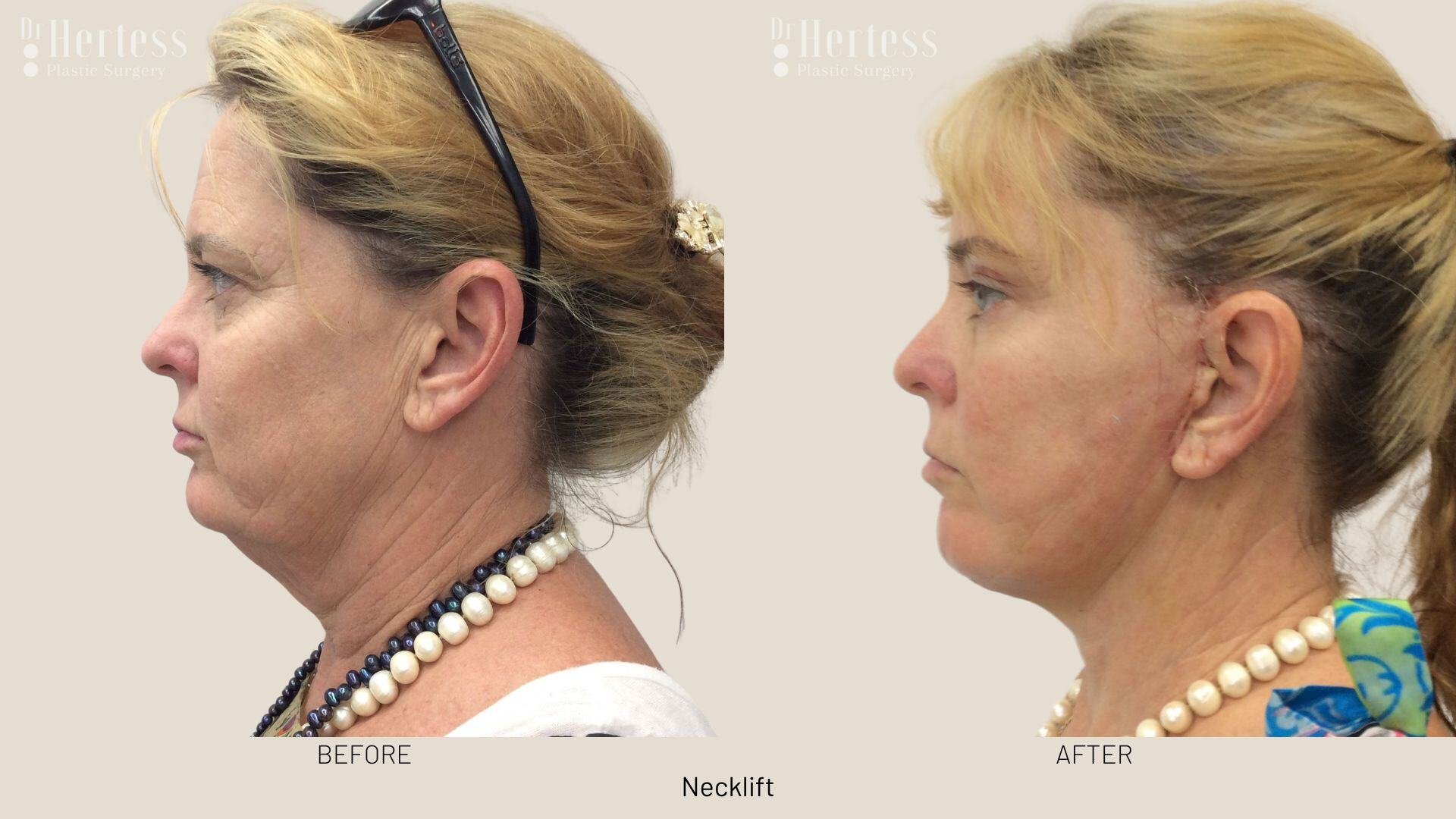 facelift before and after photos