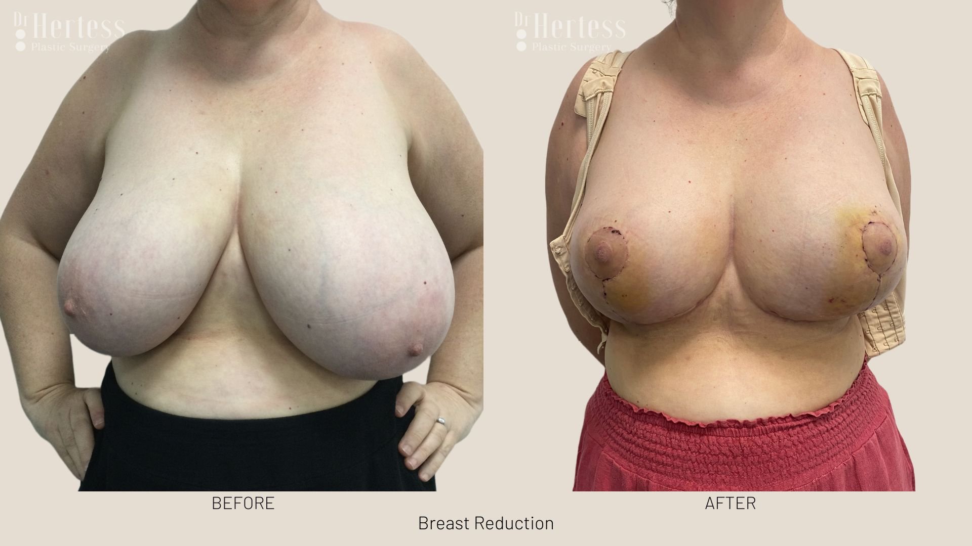 boob reduction before after