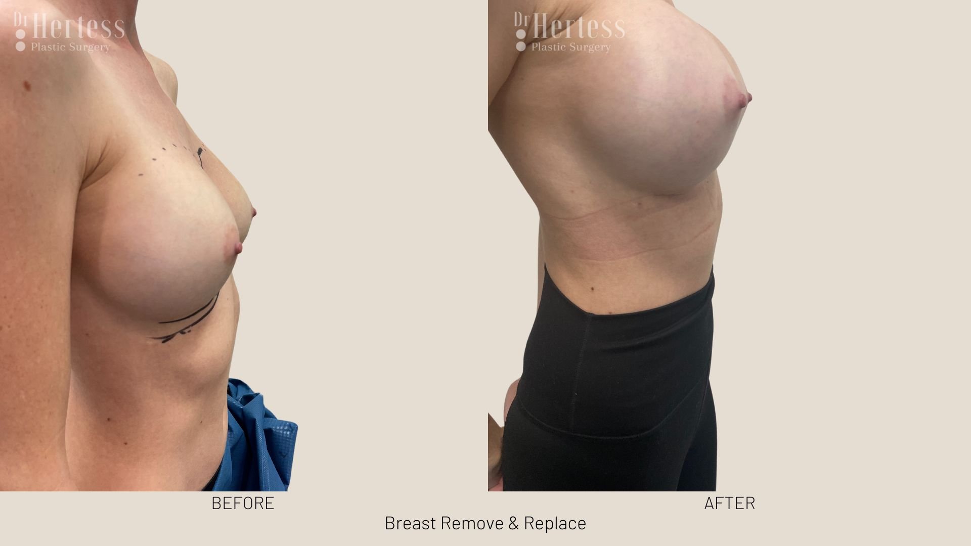 breast implant removal and replacement