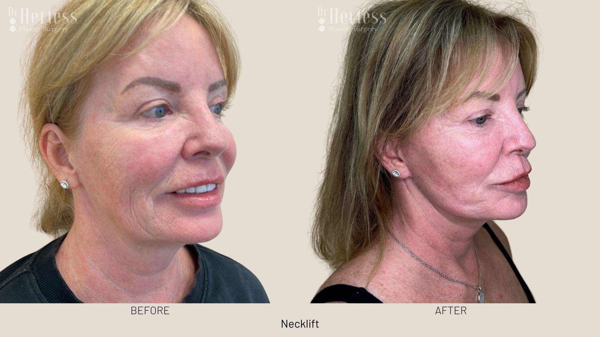 facelift before and after photos