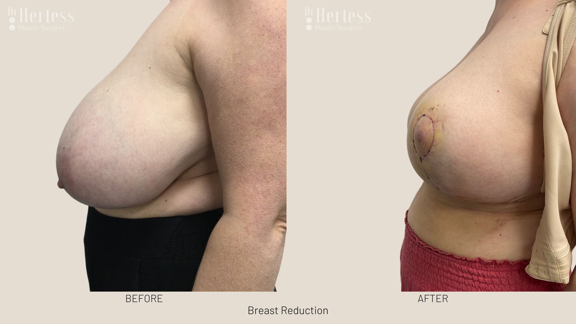 boob reduction before after