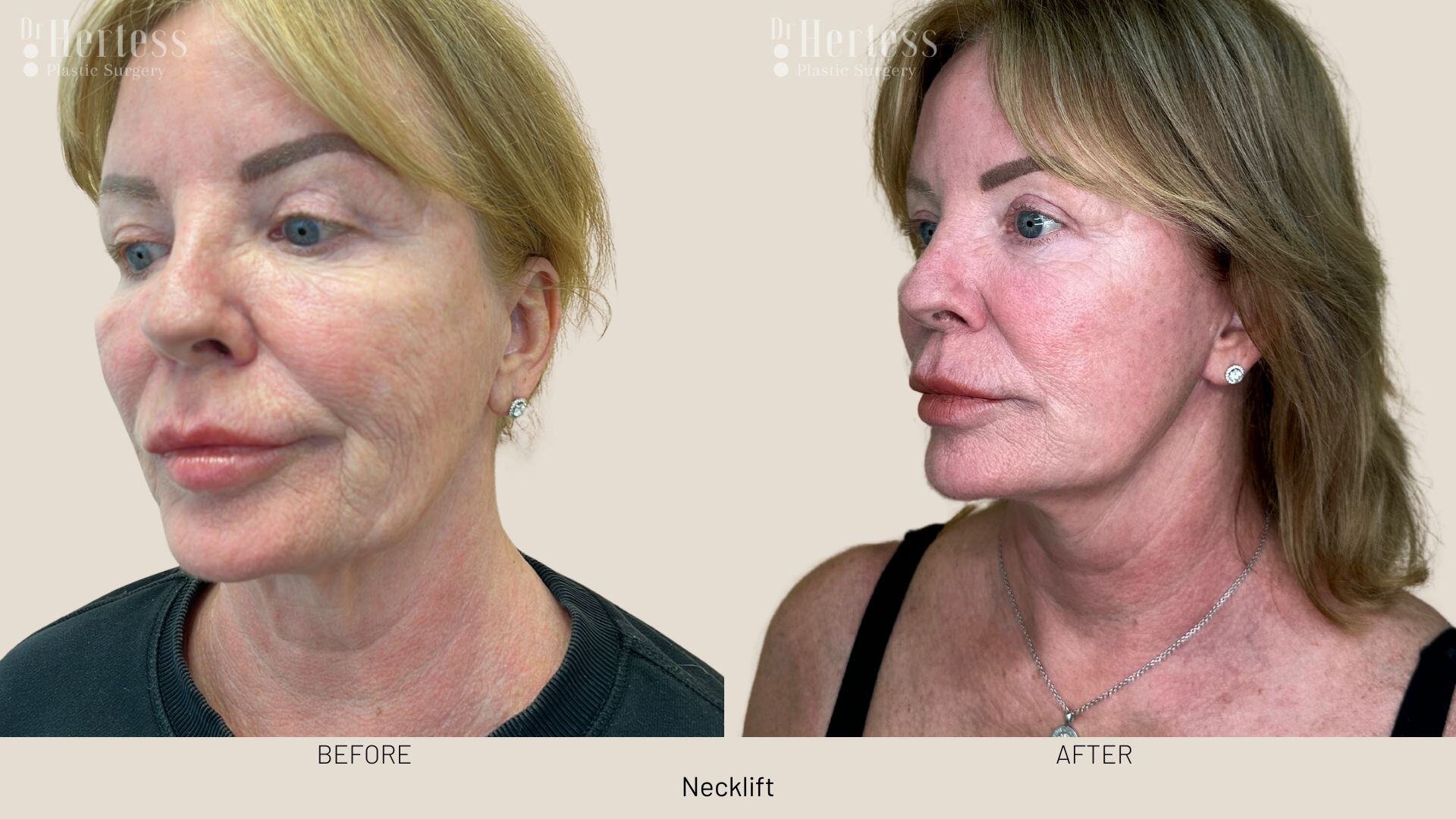 facelift before and after photos