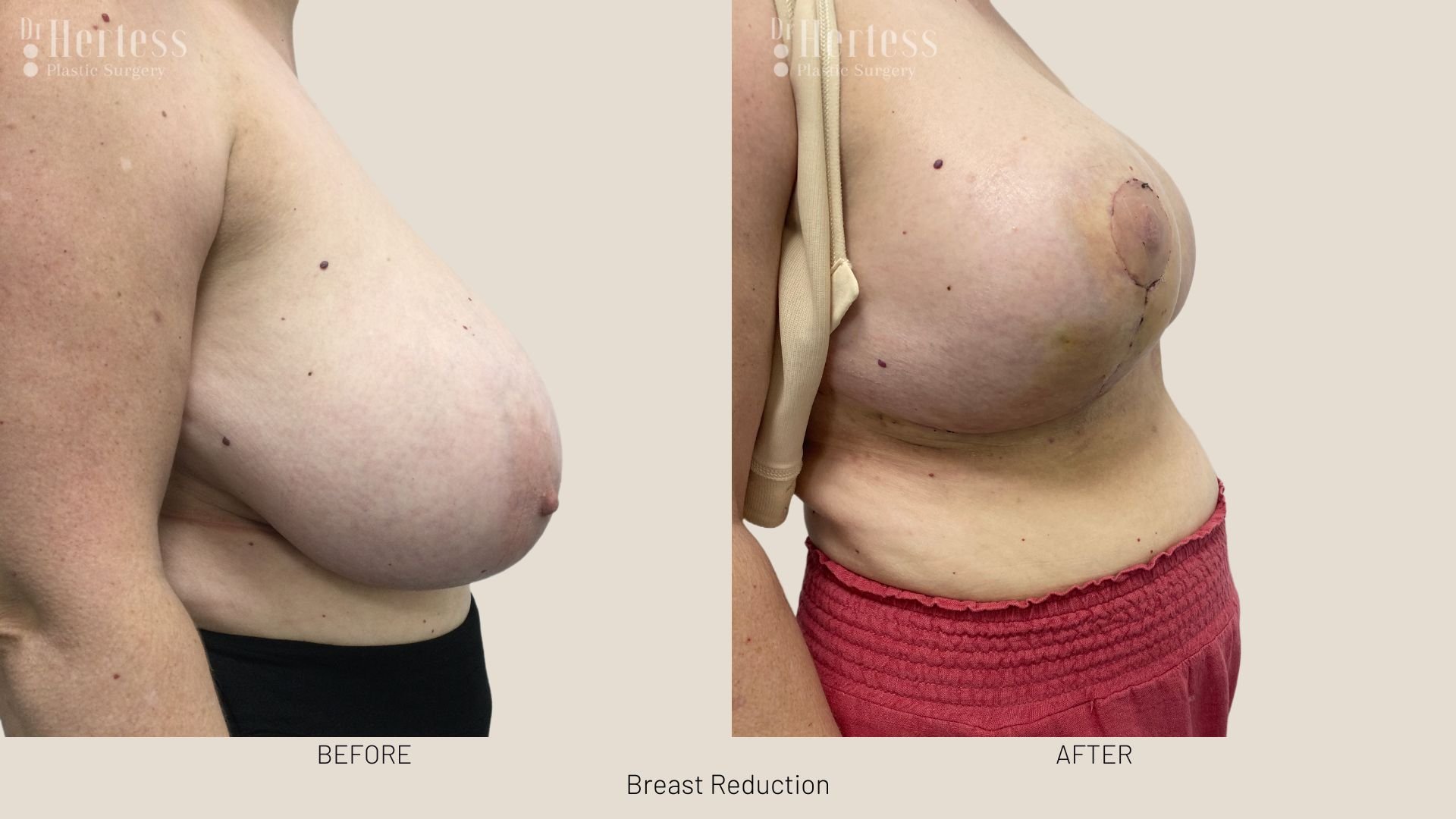 boob reduction before after