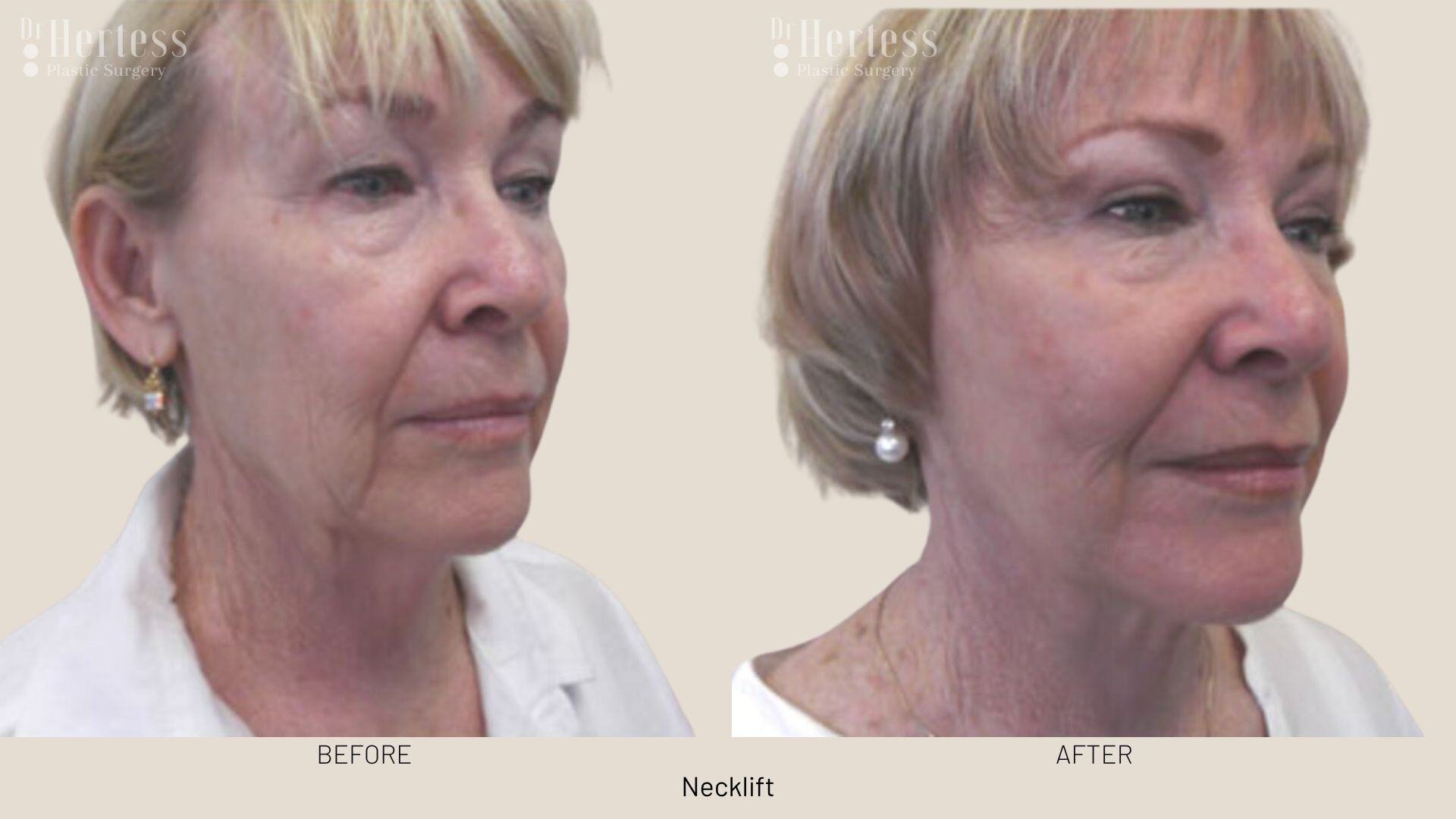 facelift before and after photos