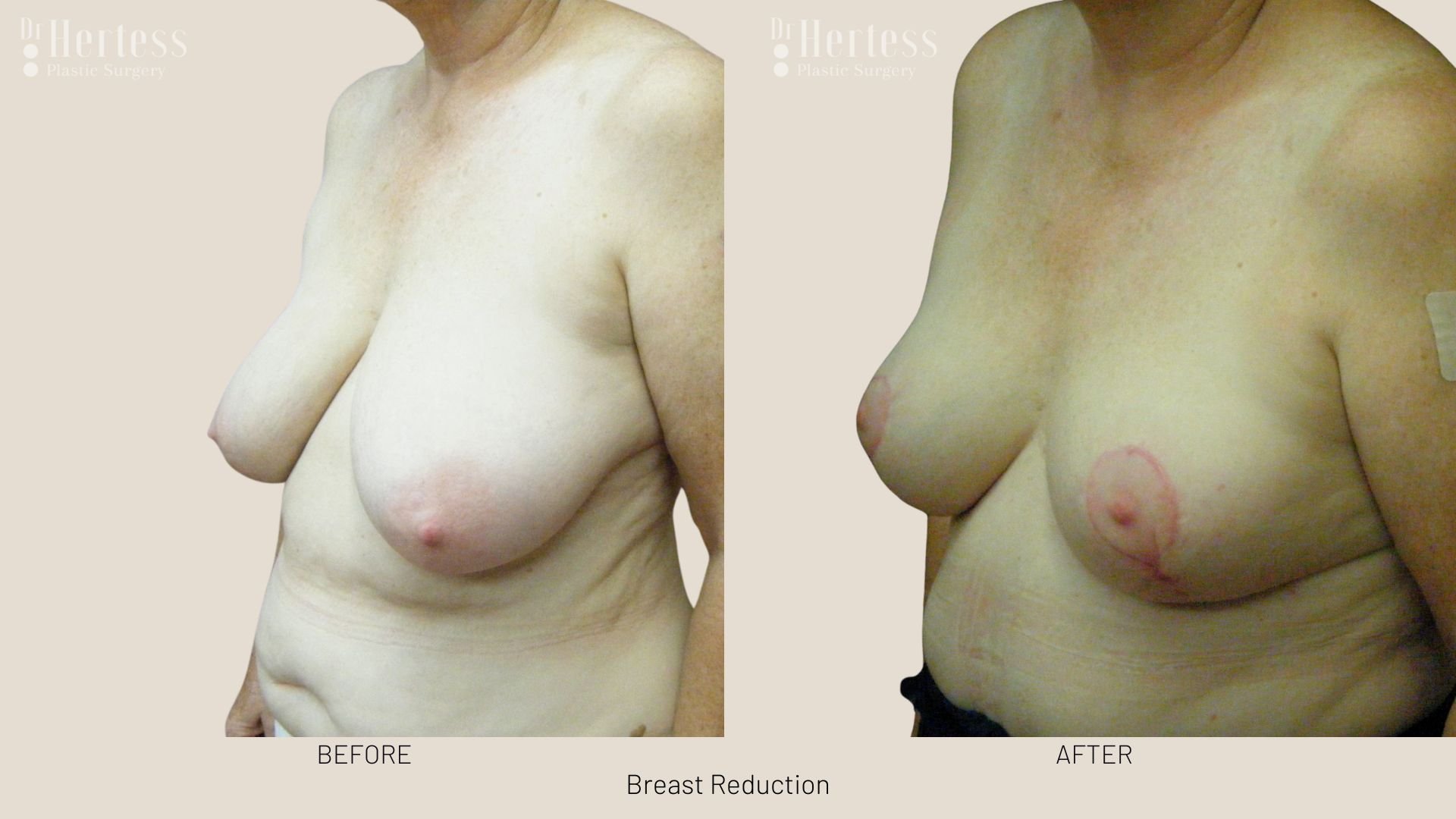 boob reduction before and after