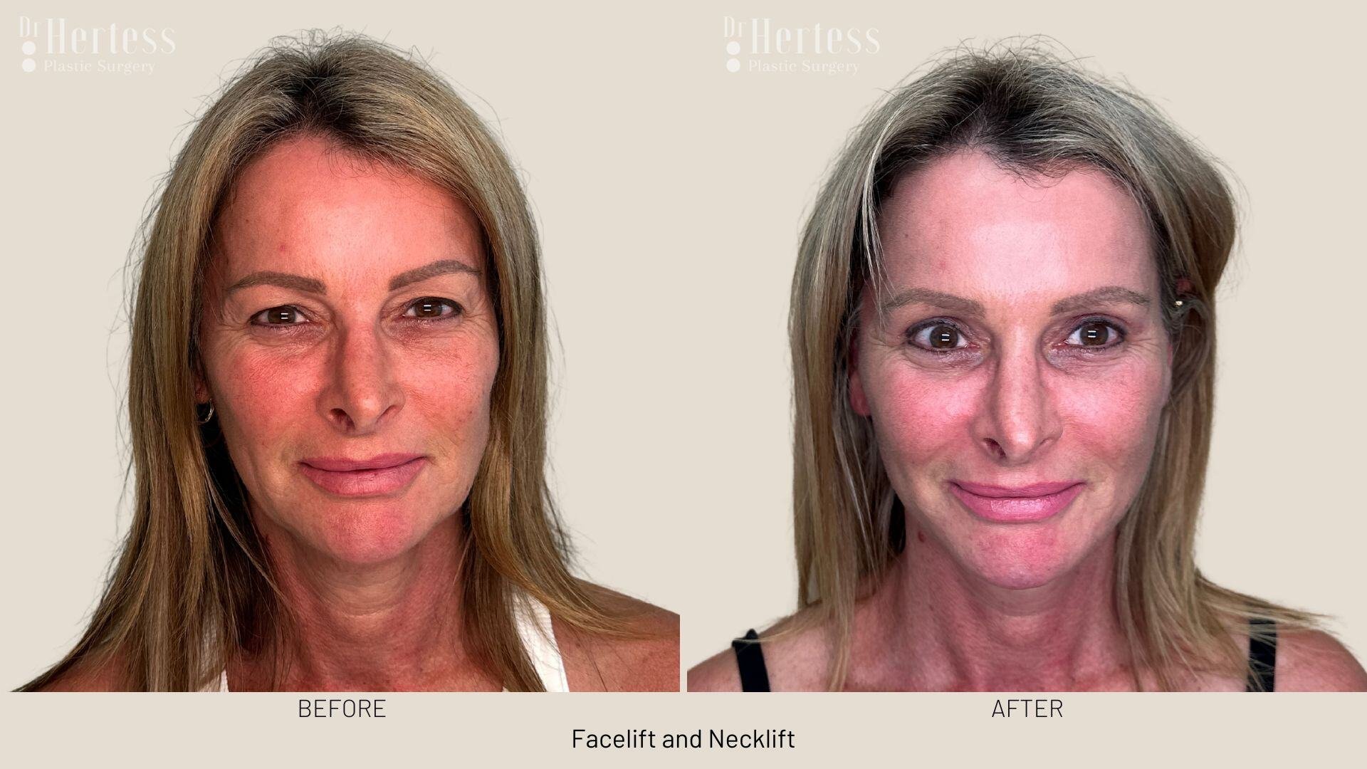 facelift before and after photos