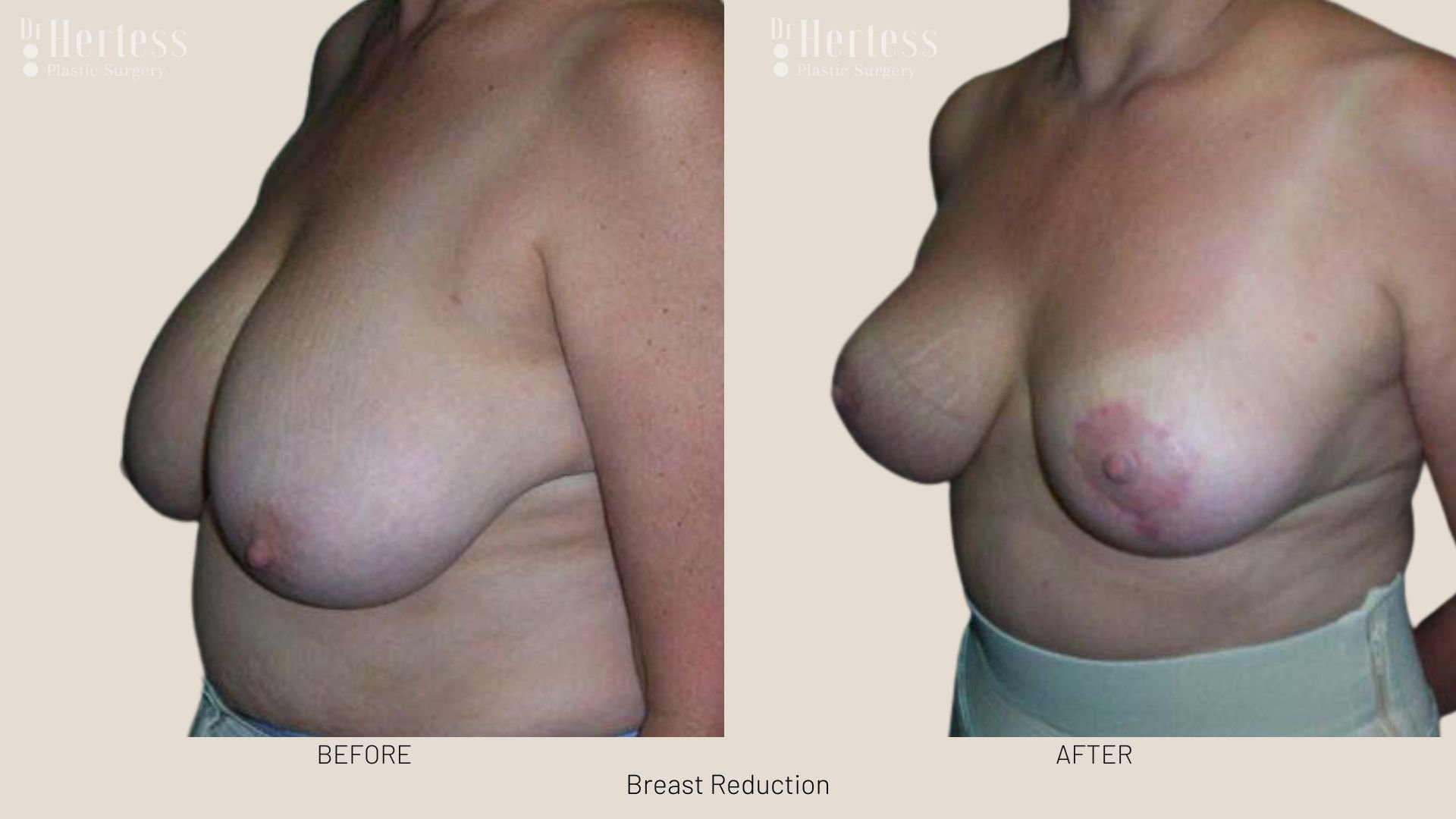 boob reduction before after