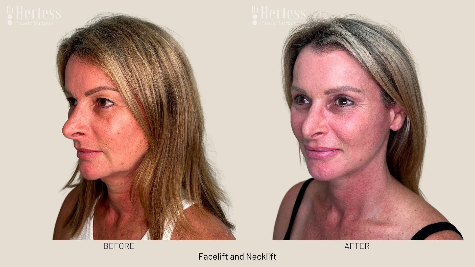 facelift before and after photos