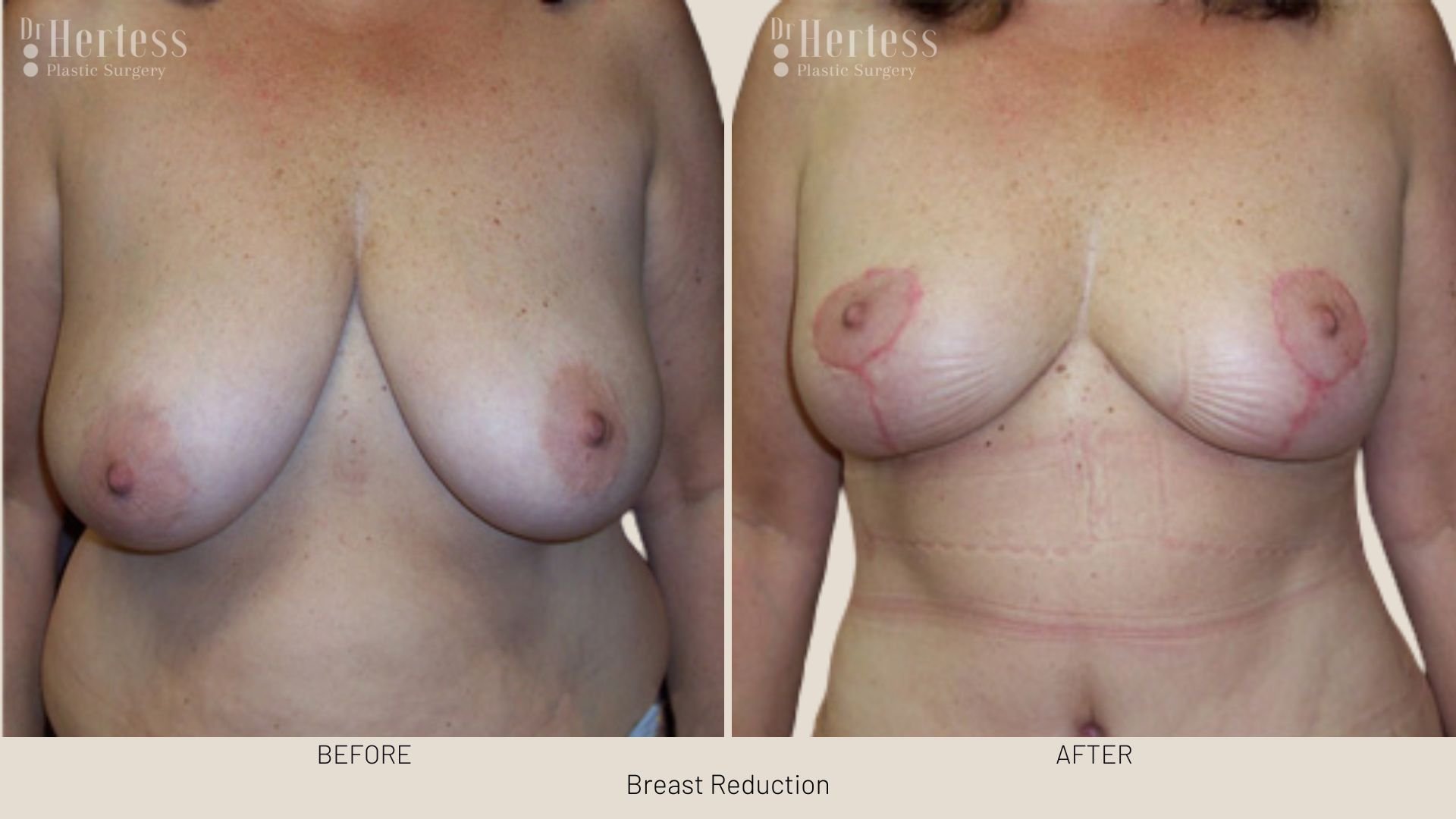 boob reduction before after