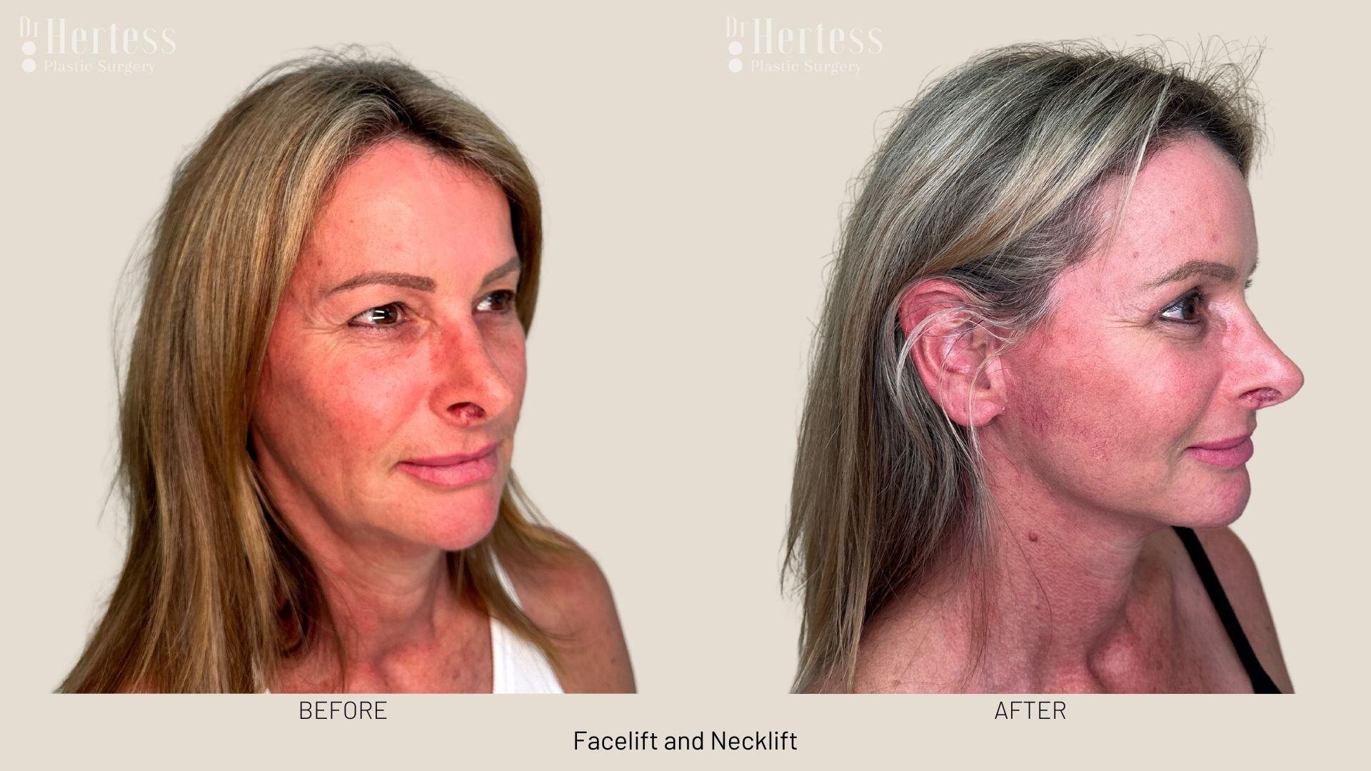 facelift before and after photos