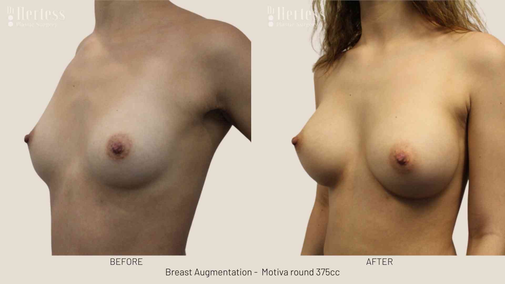 breast enlargement before and after