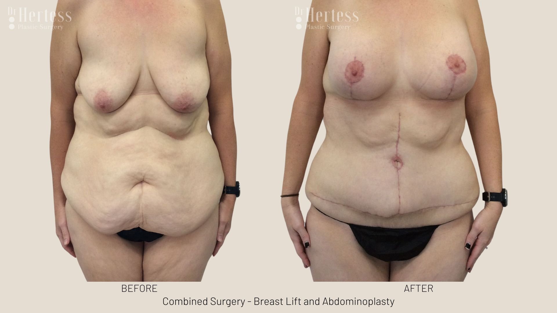 tummy tuck after pregnancy