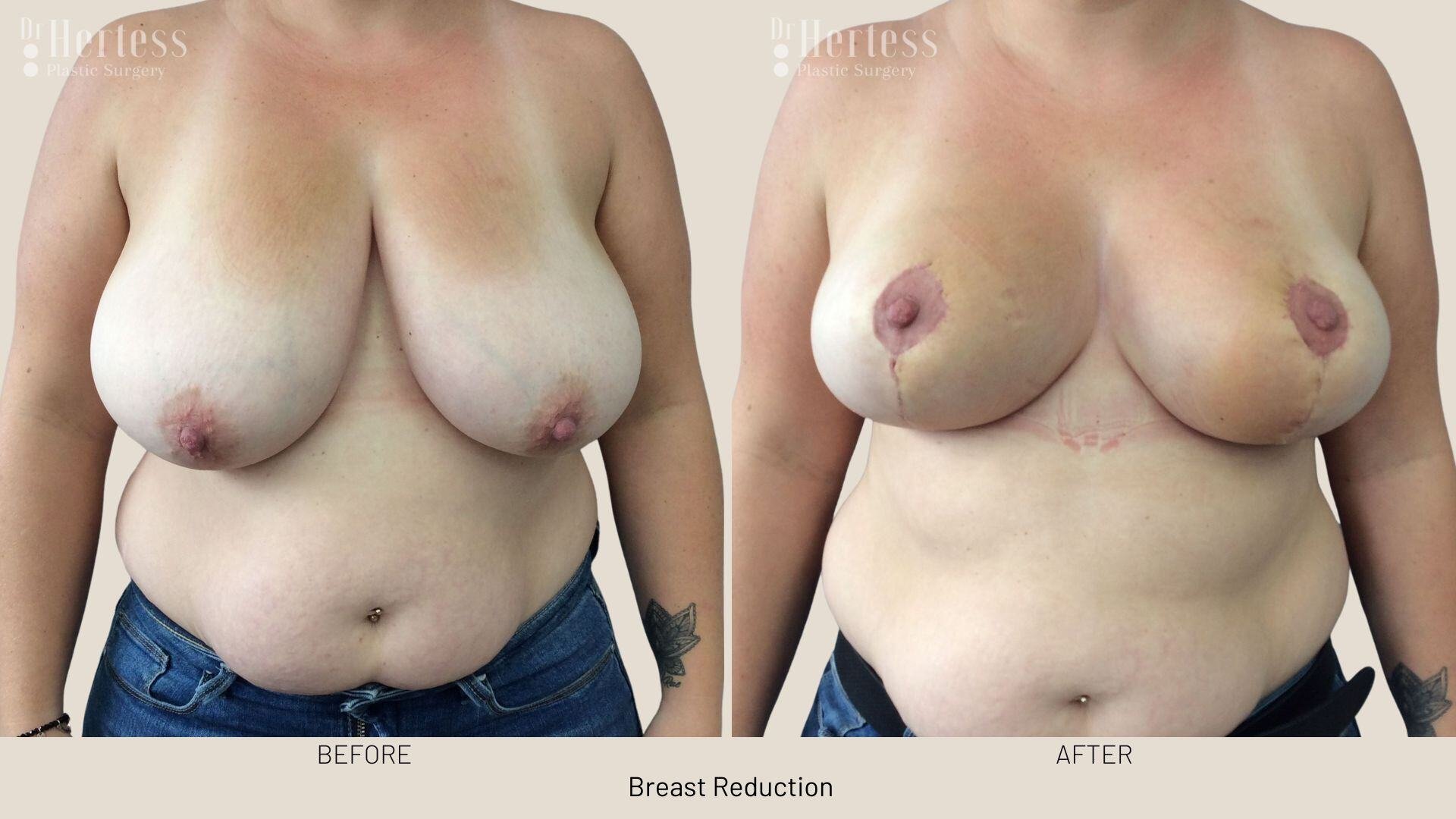 breast reduction photos