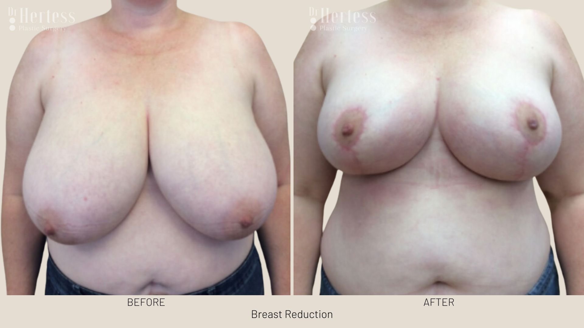 boob reduction before after