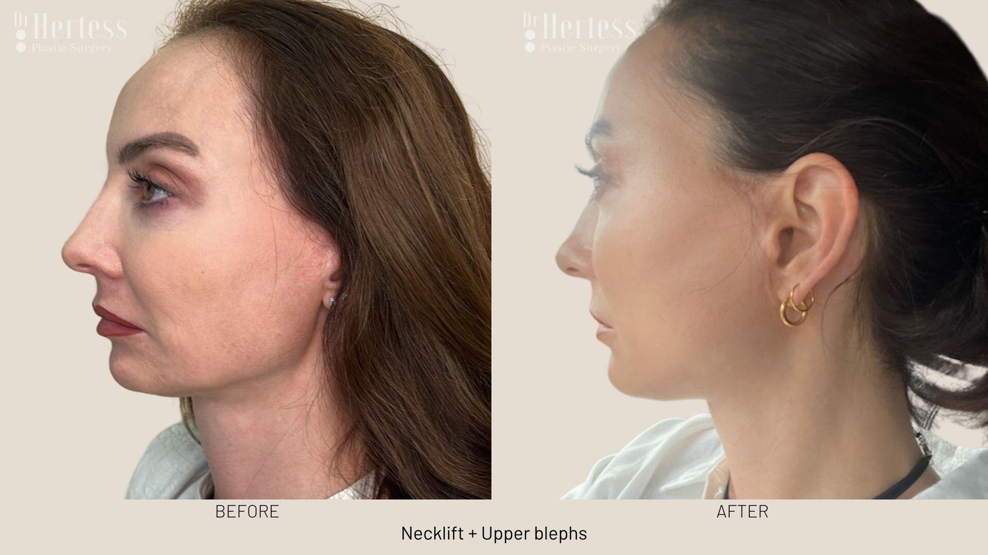 facelift photos