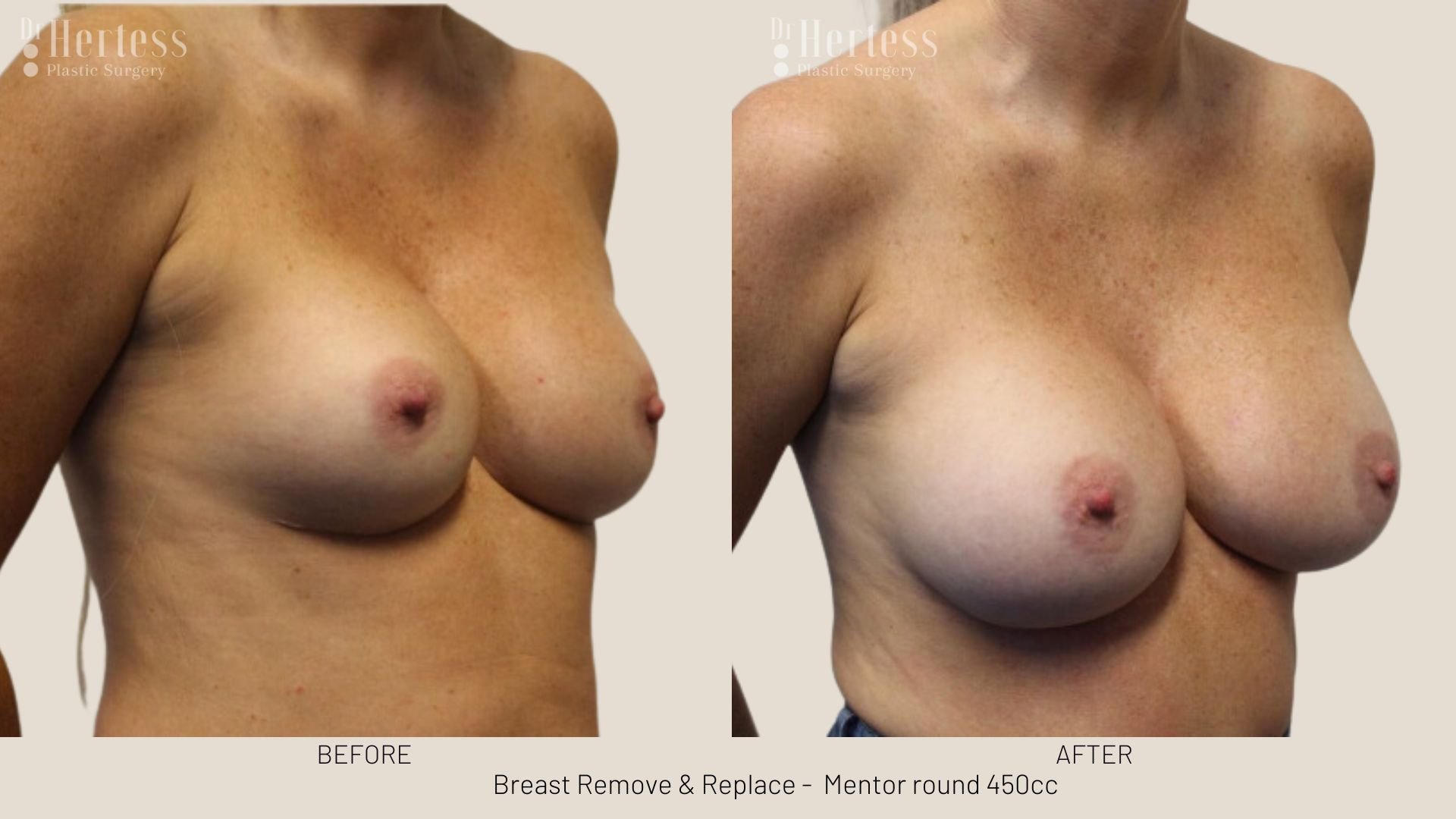 breast implant removal and replacement prices