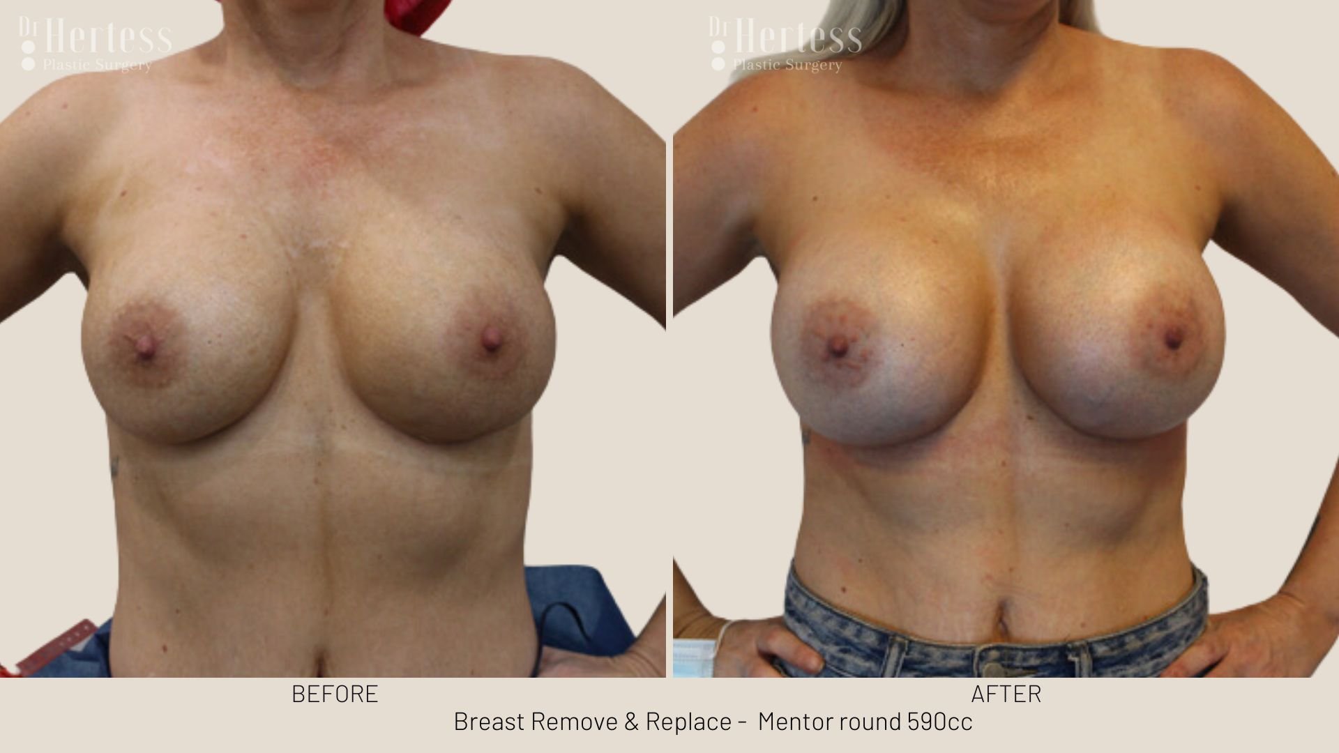 breast implant removal and replacement prices