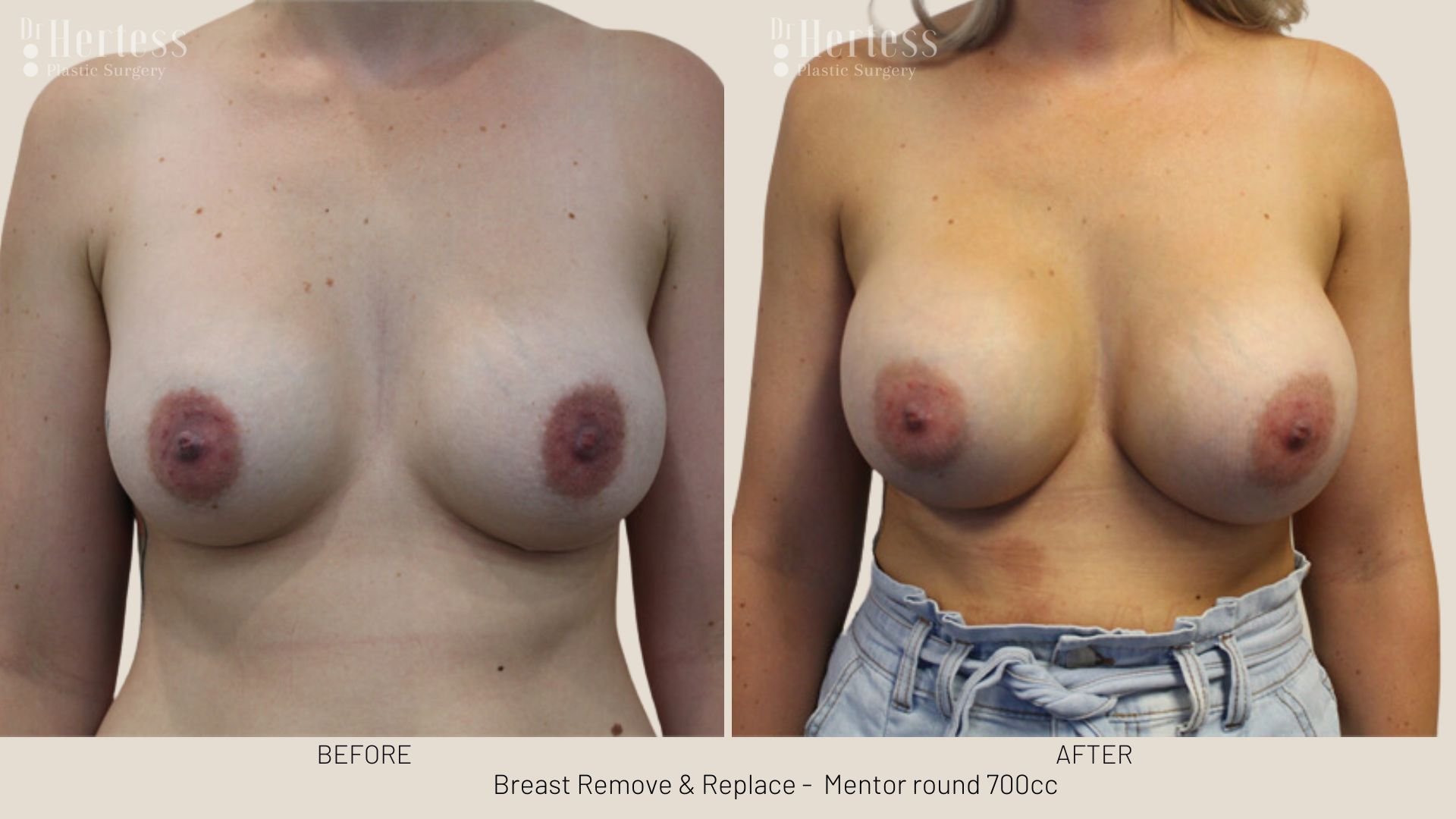 breast implant removal and replacement prices