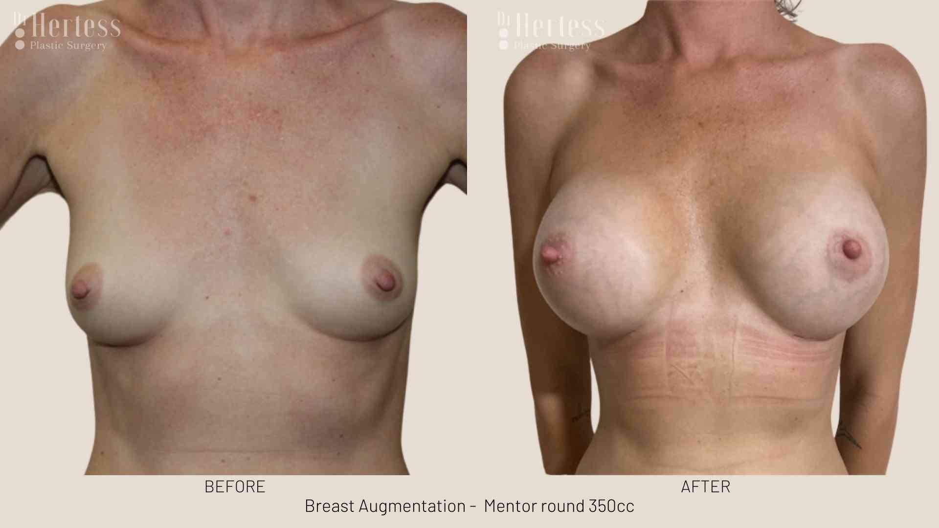 boob job before after