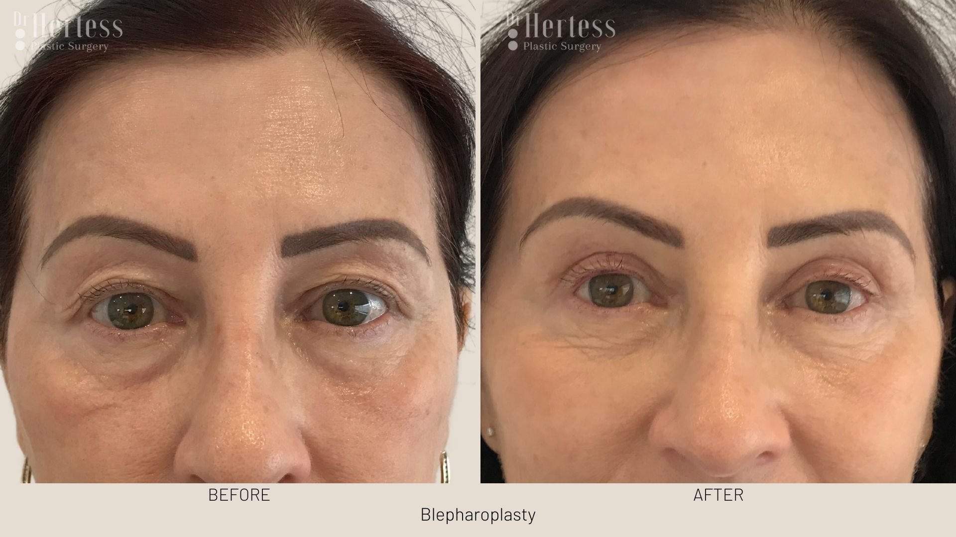 eye lift before and after