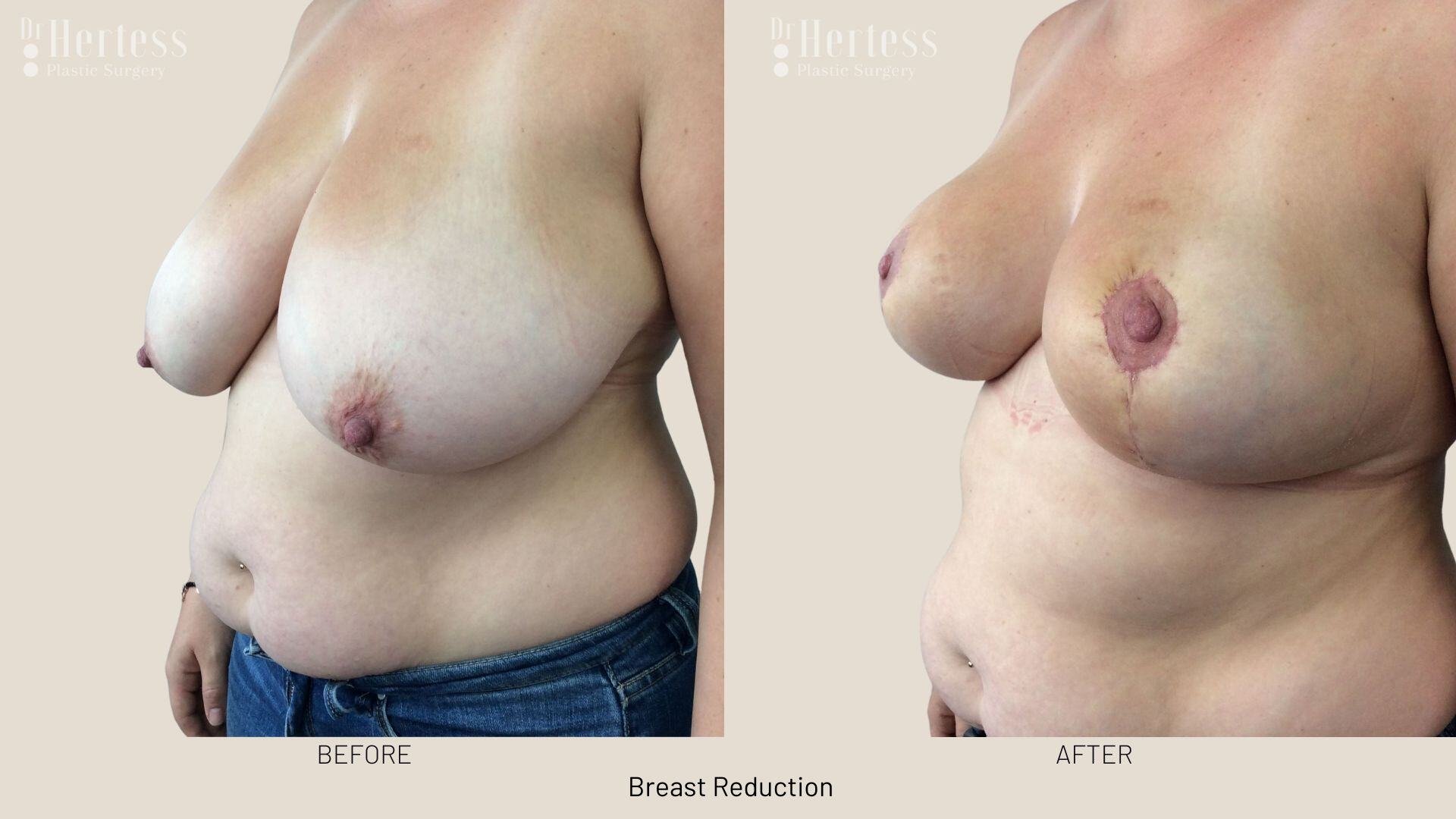 breast reduction photos