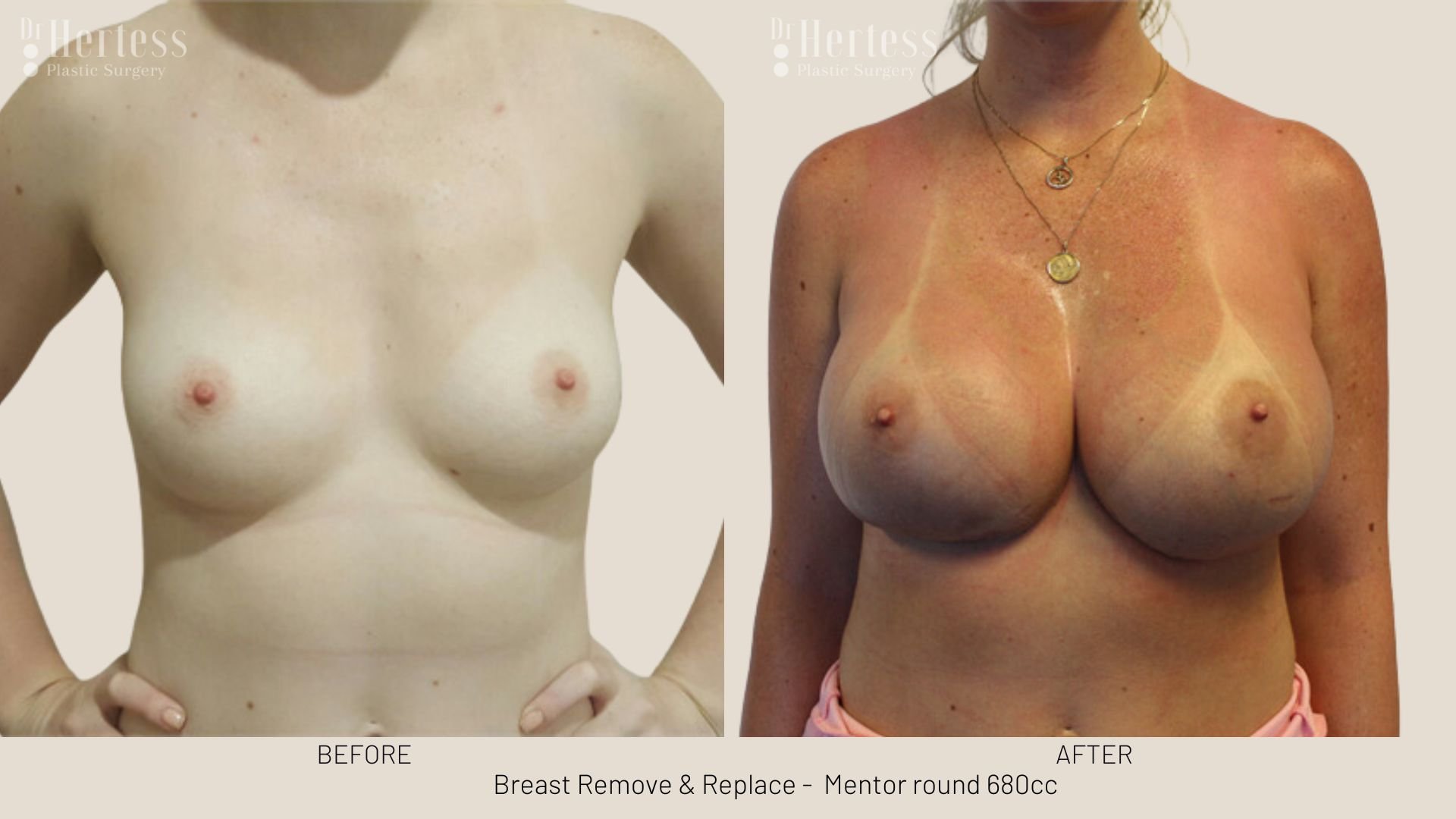 breast implant removal and replacement