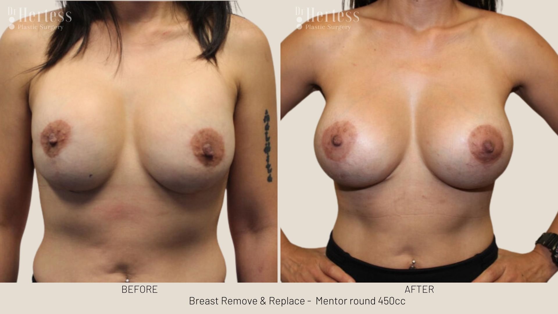breast implant removal and replacement prices