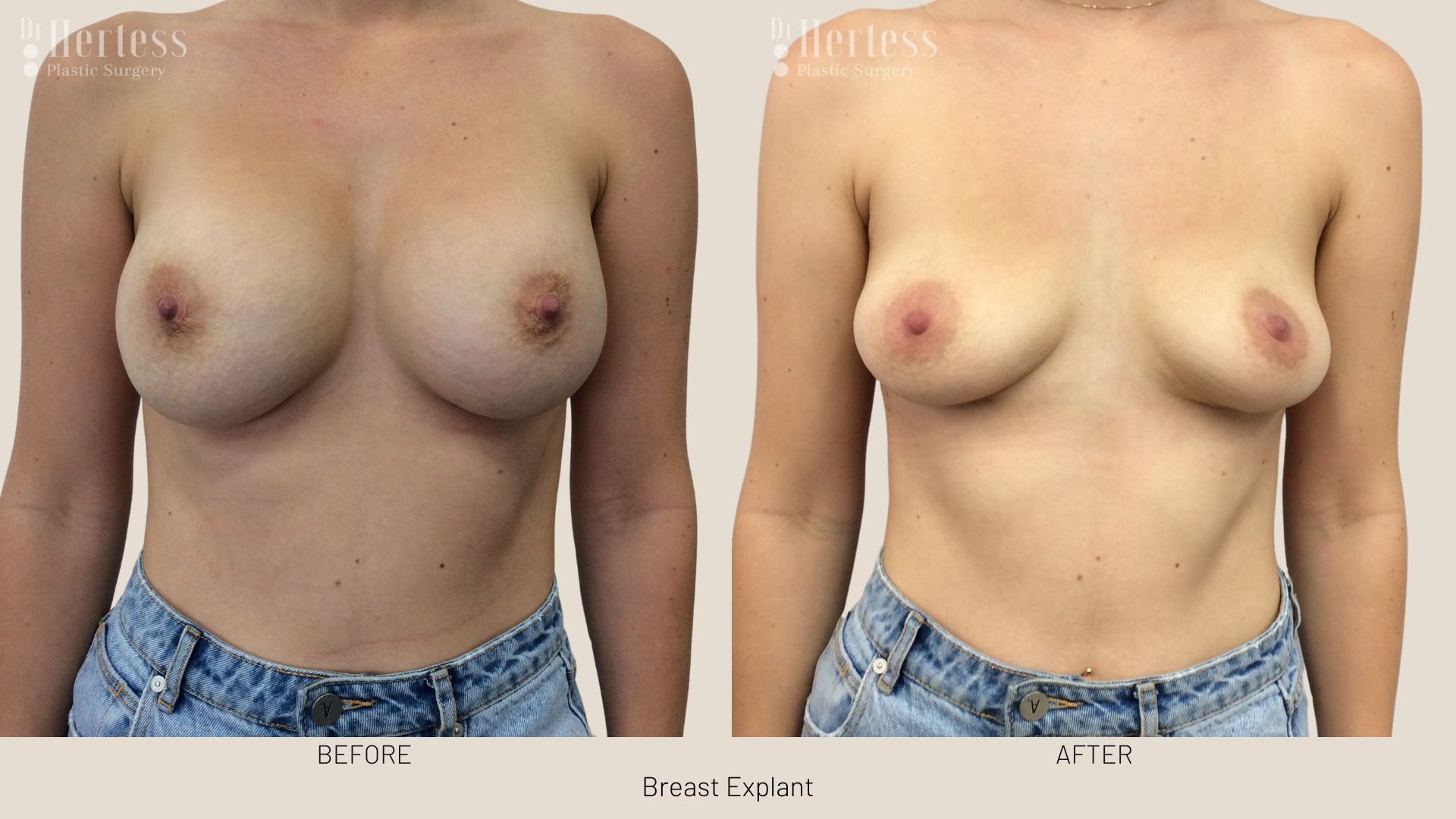 breast implant removal before and after