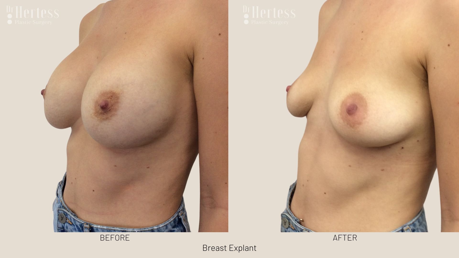 breast implant removal before and after