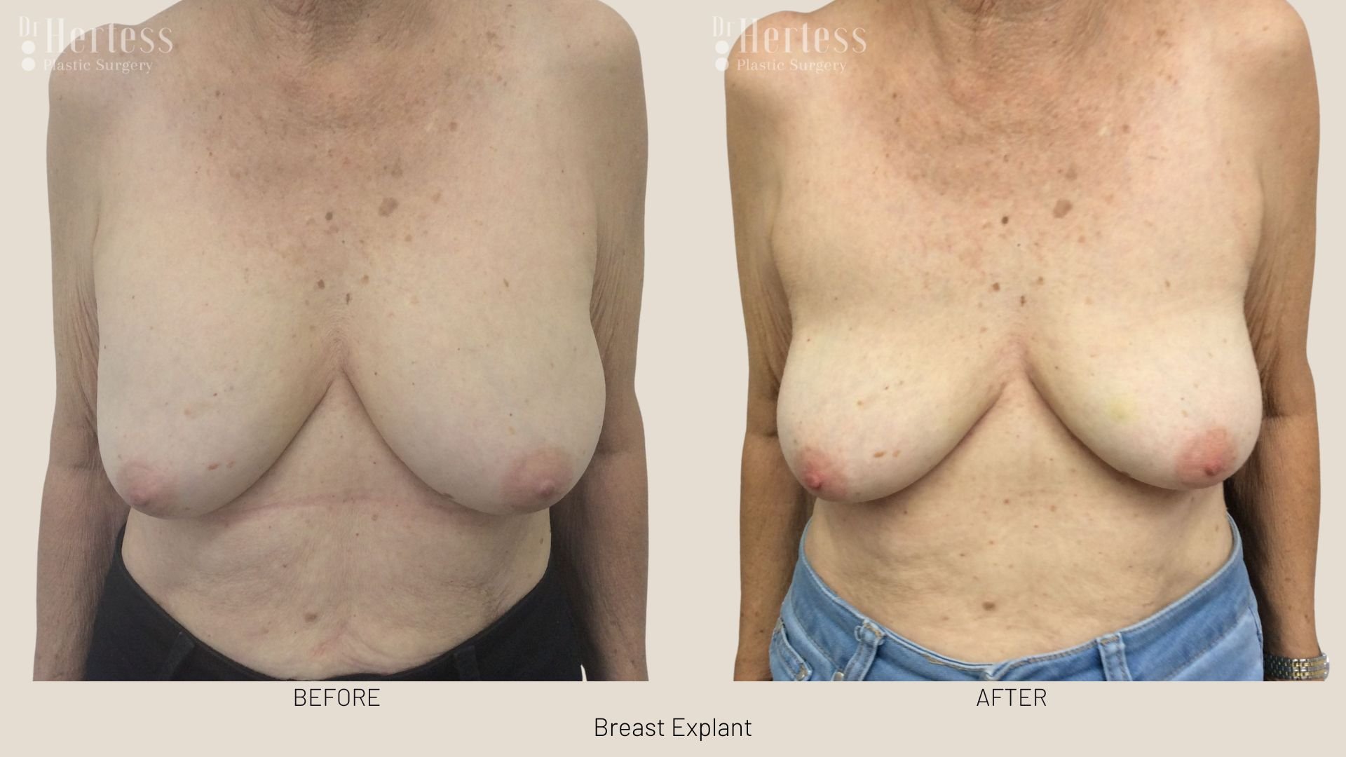 breast implant removal before and after