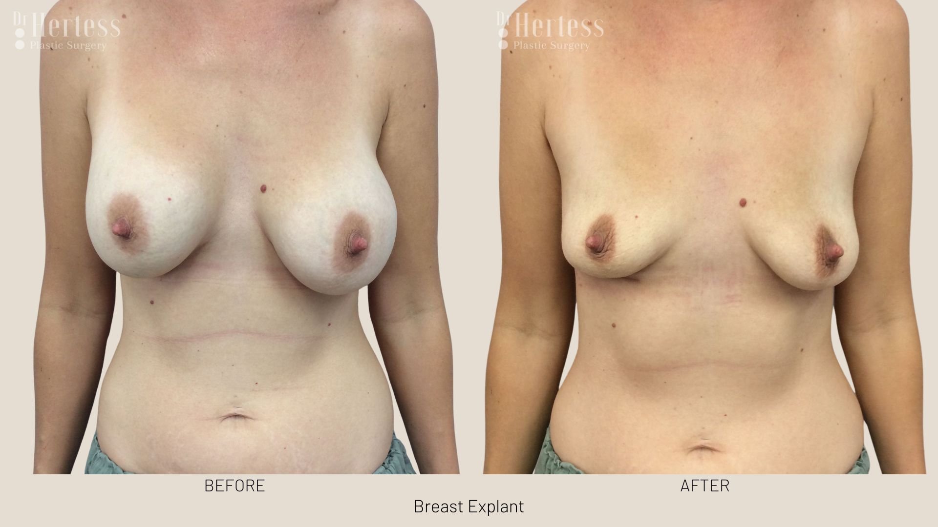 breast implant removal before and after