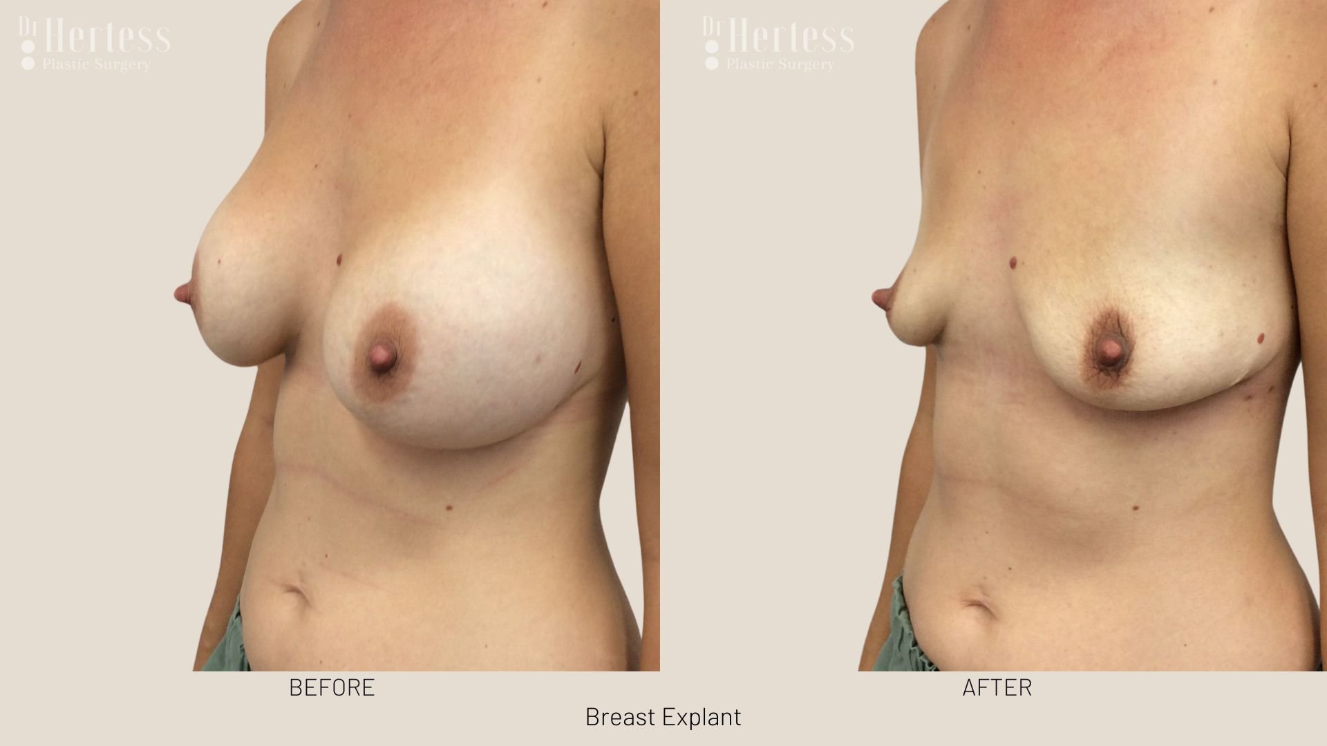 breast implant removal before and after