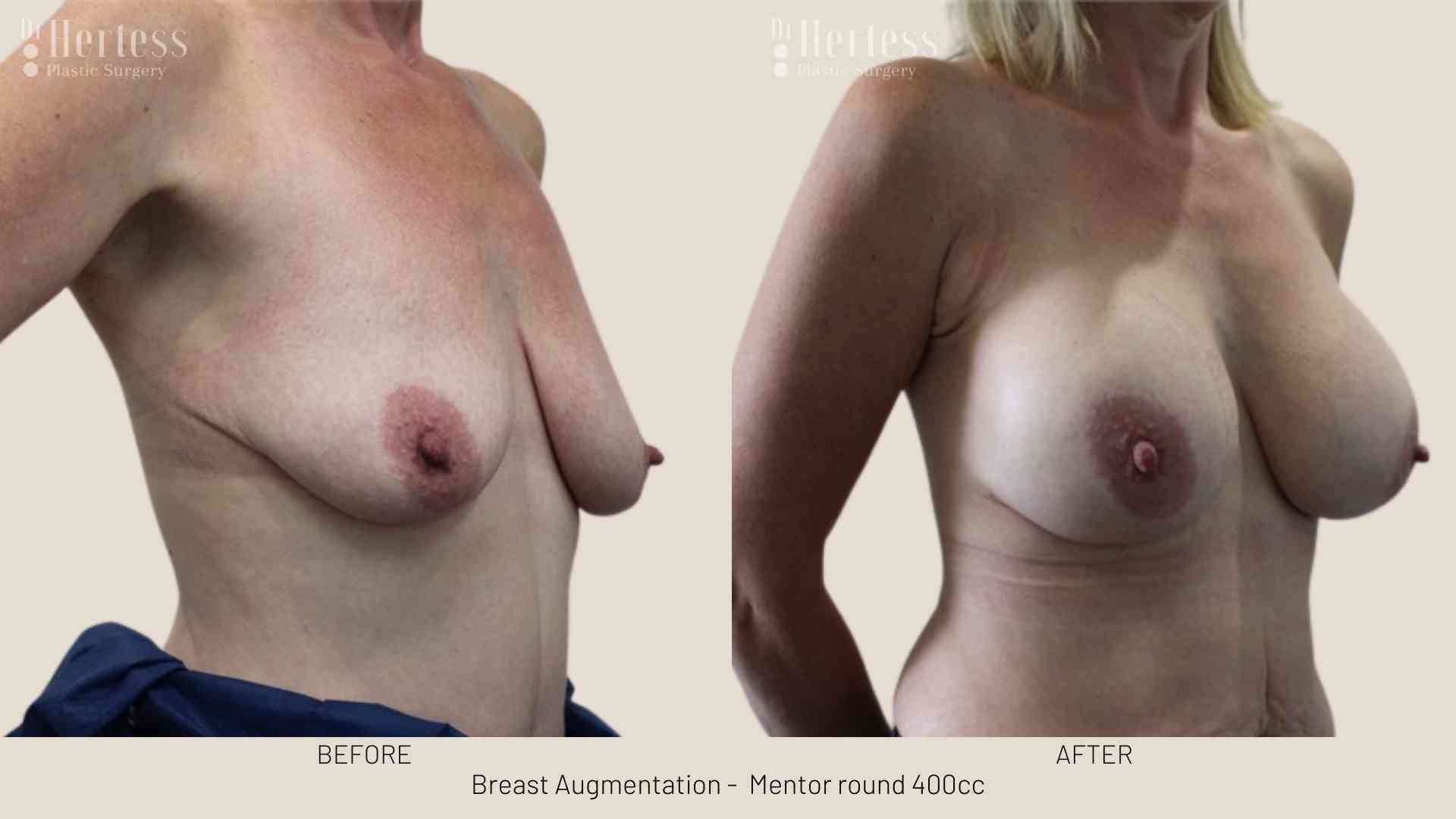 boob job before after