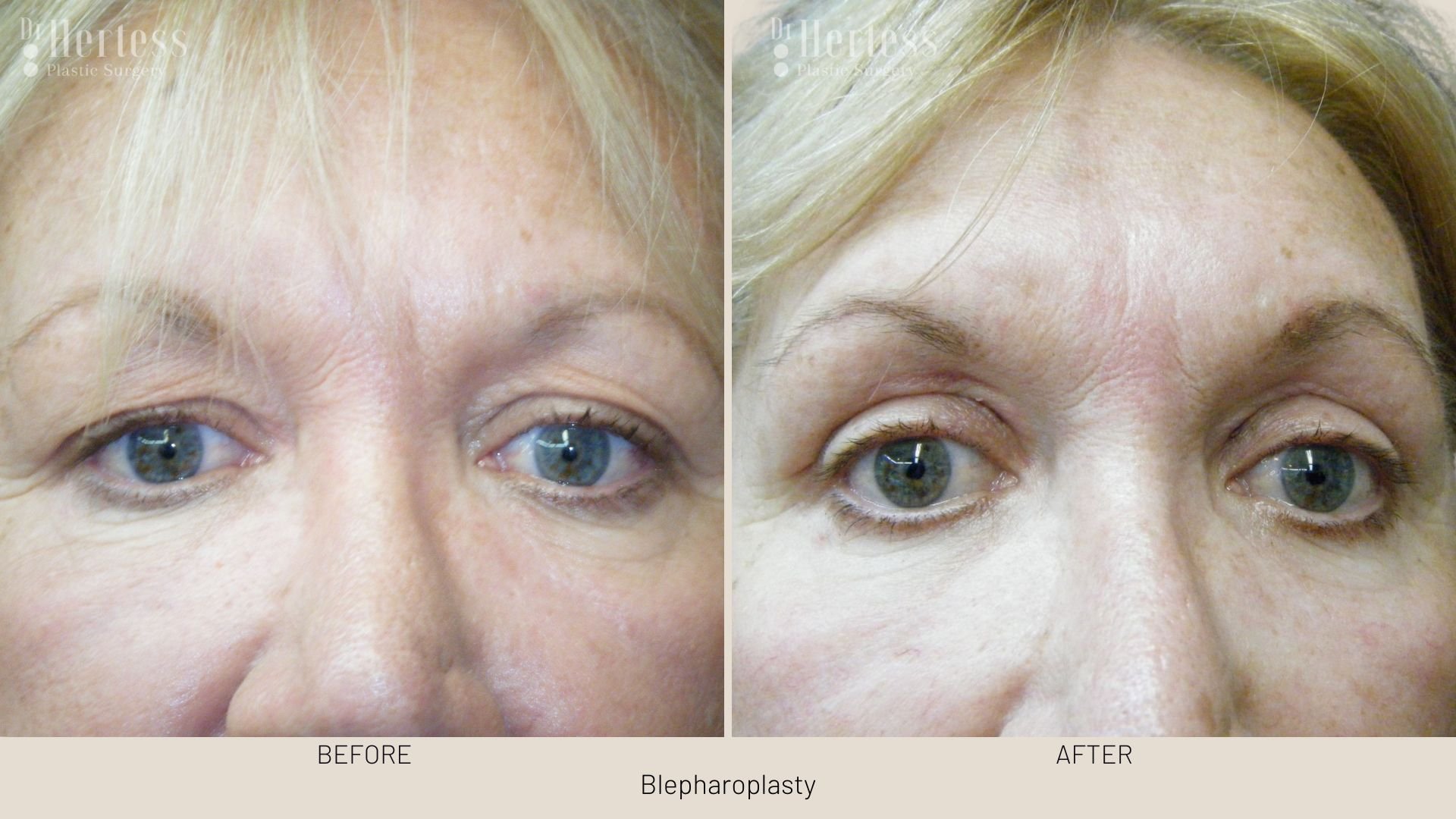 eye lift before and after