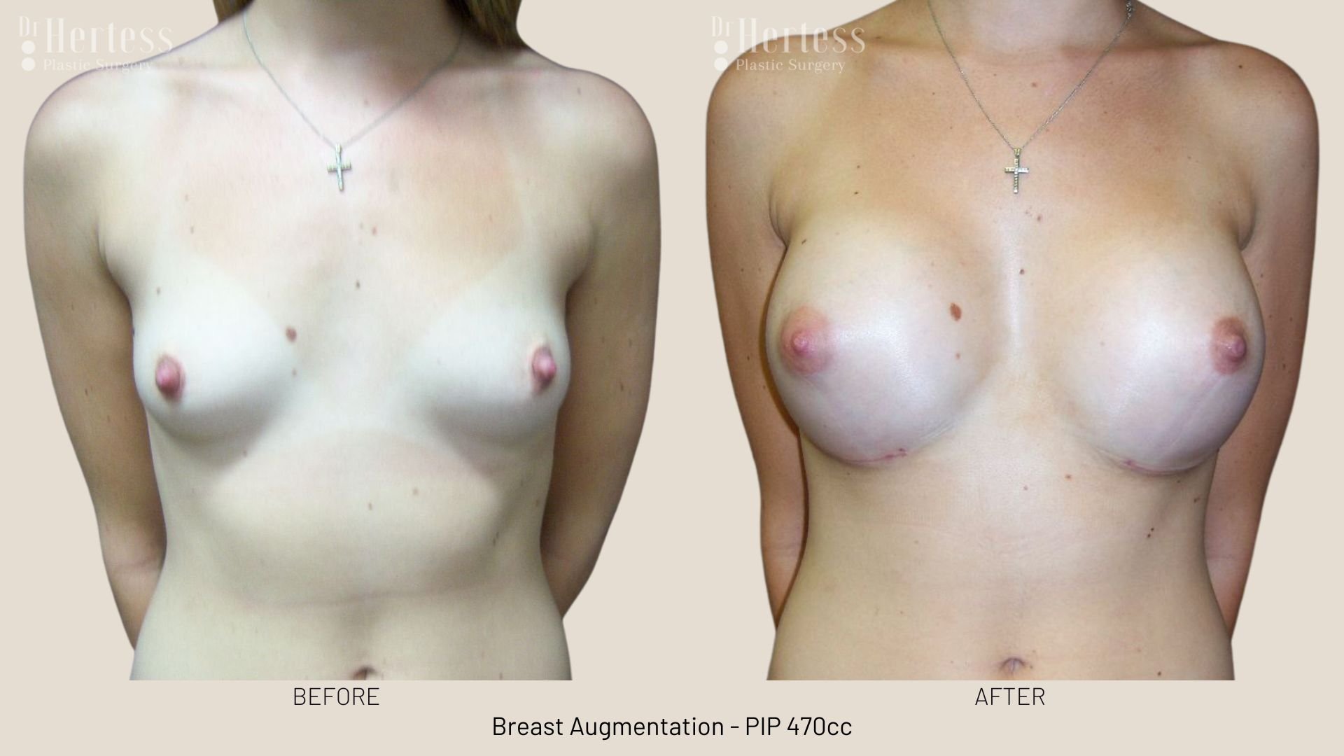 breast aug before and after