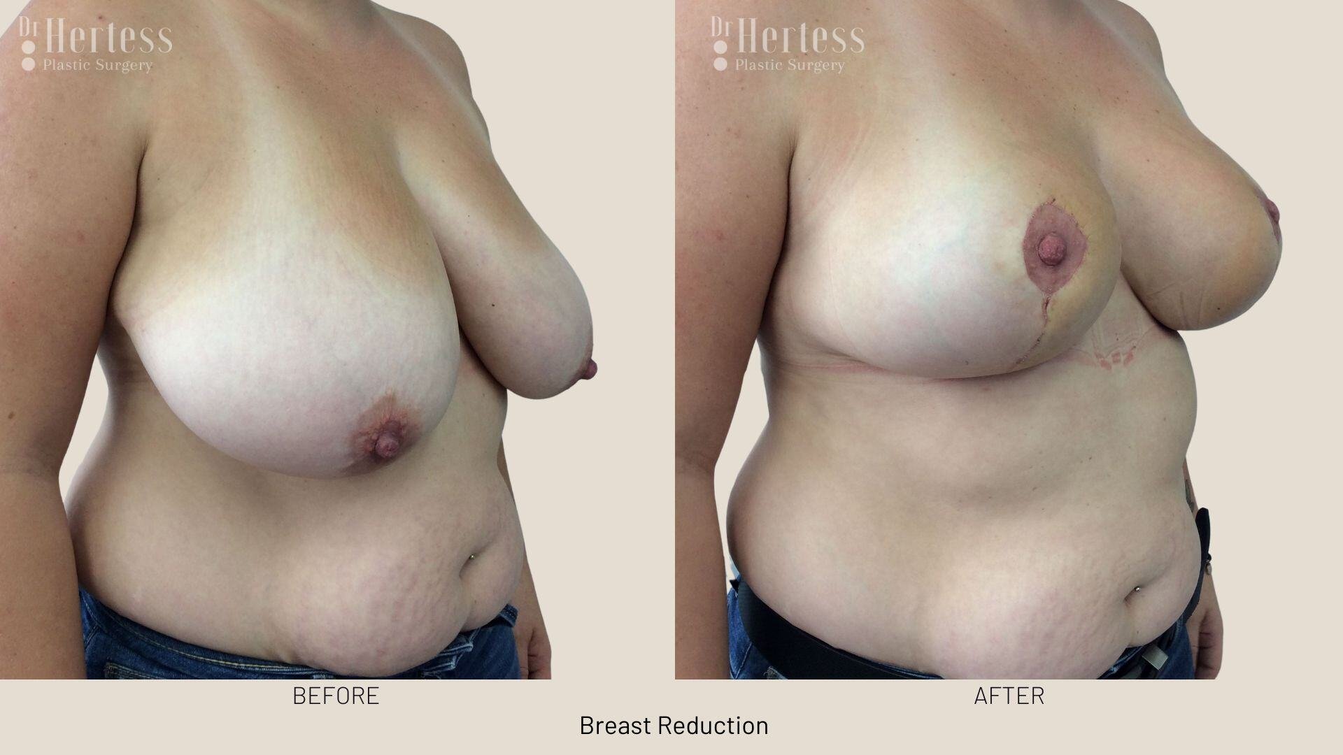 breast reduction photos